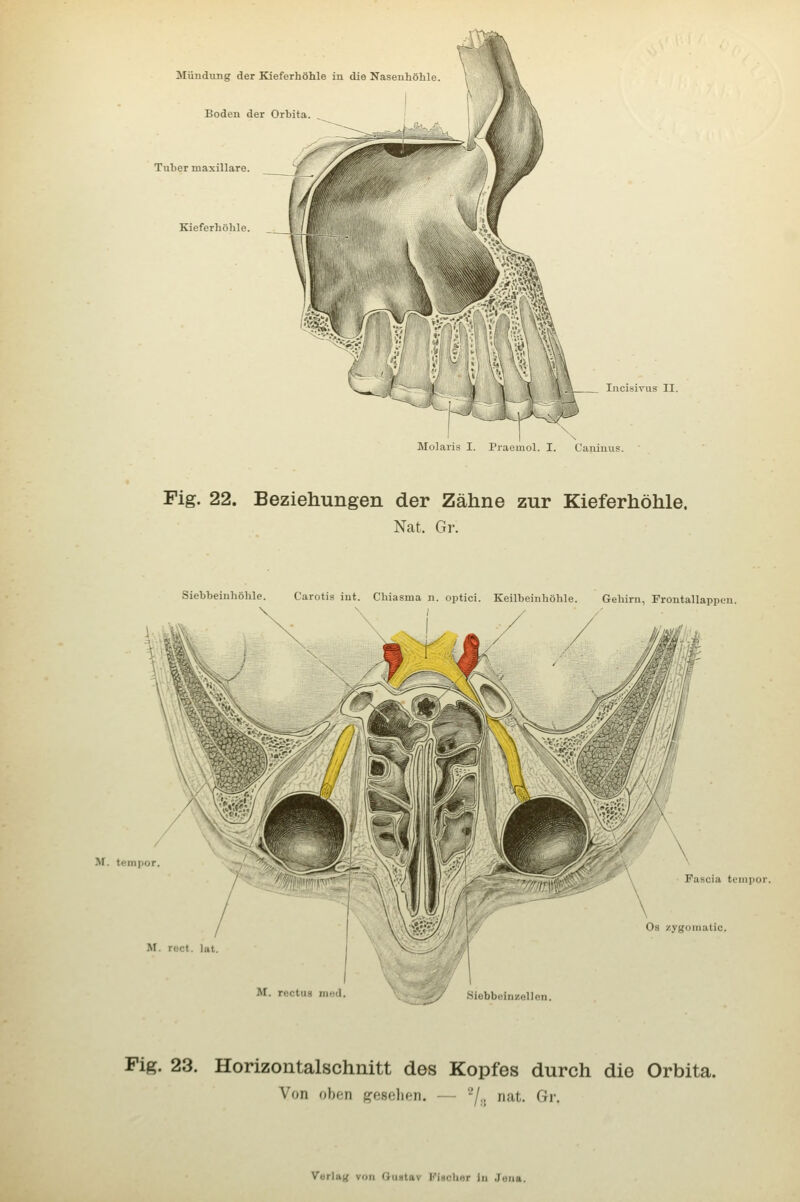 Mündung der Kieferhöhle in die Nasenhöhle. Boden der Orbita Tuher maxillare. Kieferhöhle. ^ li ^ \ \ A lucisivus II. Molaris I. Praemol. I. Caninus. Fig. 22. Beziehungen der Zähne zur Kieferhöhle. Nat. Gr. Siebbeinhöhle. Carotis int. Chiasma n. optici. Keilbeinhöhle. Gehirn, Frontallappen. >r. tempor. Fascia tempor Os zygoinatic. M. rcct. lat M. rectug med Siebbeinzollon. Fig. 23. Horizontalschnitt des Kopfes durch die Orbita. Von oben ((osclif-n. — '-'/., nat. Gi-.