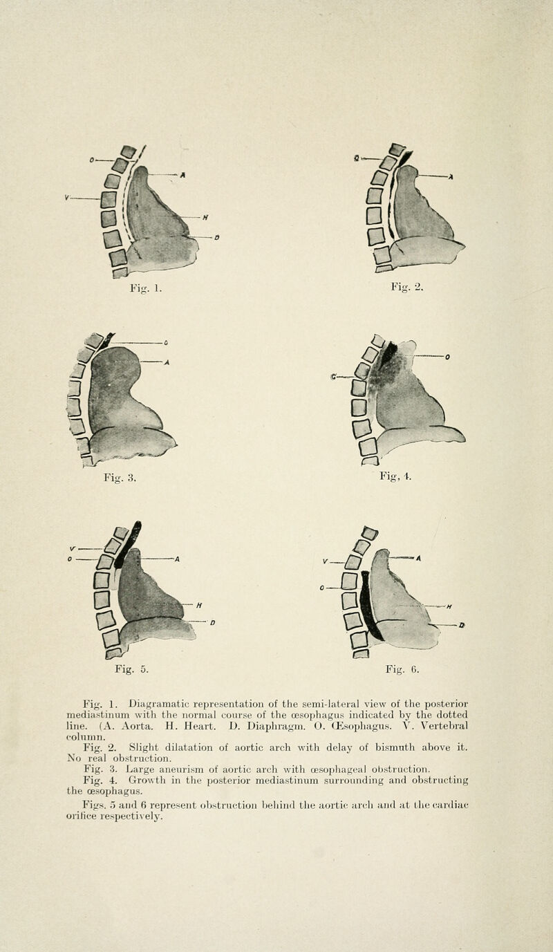 c=*- Fiff. 2. v^~* ra Fig. 3. Fie, \. Fig. 6. Fig. 1. Diagraraatic representation of the semi-lateral view of the posterior mediastinum with the normal course of the oesophagus indicated by the dotted line. (A. Aorta. H. Heart. JJ. Diaphragm. O. Oesophagus. V. Vertebral column. Fig. 2. Slight dilatation of aortic arch with delay of bismuth above it. No real obstruction. Fig. 3. Large aneurism of aortic arch with oesophageal obstruction. Fig. 4. Growth in the posterior mediastinum surrounding and obstructing the oesophagus. Figs. 5 and 6 represent obstruction behind the aortic arch and at the cardiac orifice respectively.