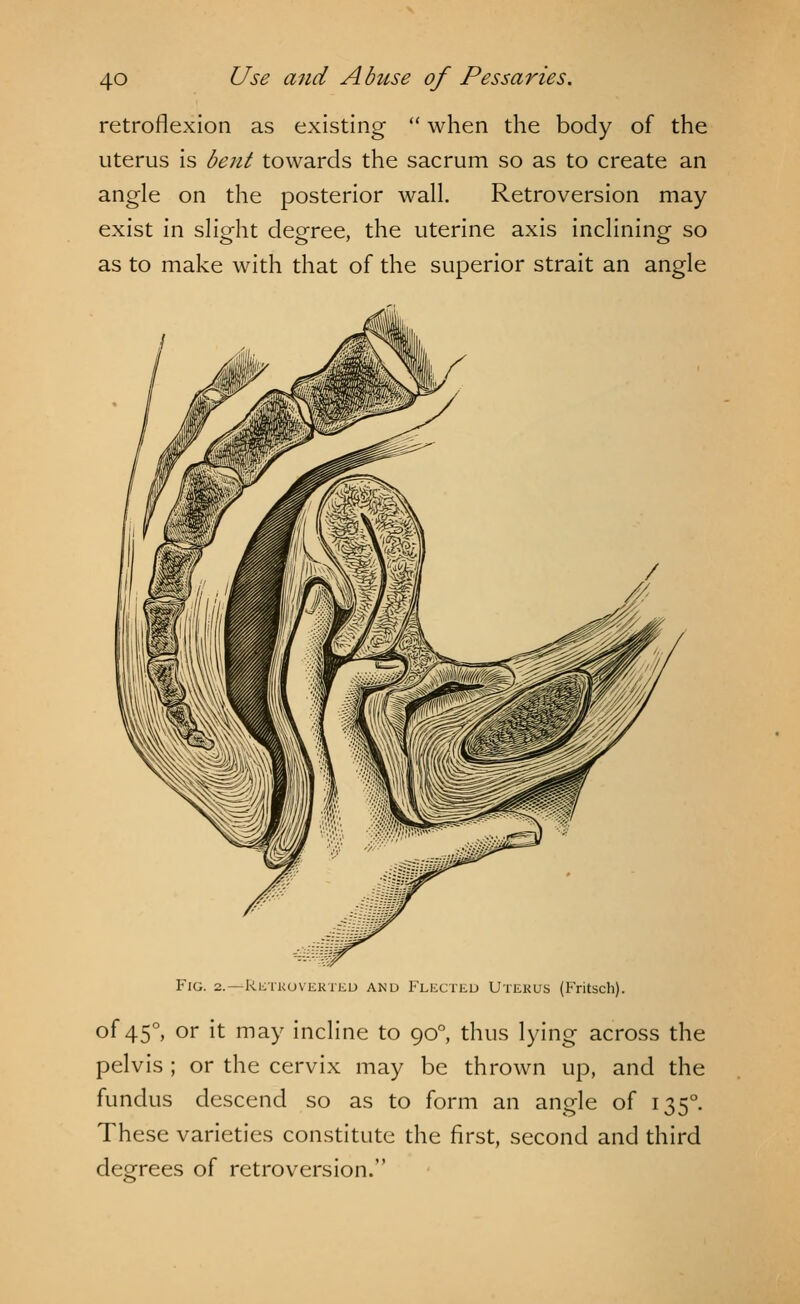 retroflexion as existing  when the body of the uterus is bent towards the sacrum so as to create an angle on the posterior wall. Retroversion may exist in slight degree, the uterine axis inclining so as to make with that of the superior strait an angle Fig. 2.—Retroverteu and Flected Uterus (Fritsch). of 450, or it may incline to 900, thus lying across the pelvis ; or the cervix may be thrown up, and the fundus descend so as to form an angle of 1350. These varieties constitute the first, second and third decrees of retroversion.