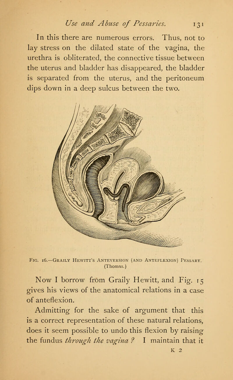 In this there are numerous errors. Thus, not to lay stress on the dilated state of the vagina, the urethra is obliterated, the connective tissue between the uterus and bladder has disappeared, the bladder is separated from the uterus, and the peritoneum dips down in a deep sulcus between the two. Fig. 16.—Graily Hewitt's Anteveksion (and Anteflexion) Pessary. (Thomas.) Now I borrow from Graily Hewitt, and Fig. 15 gives his views of the anatomical relations in a case of anteflexion. Admitting; for the sake of argument that this is a correct representation of these natural relations, does it seem possible to undo this flexion by raising the fundus through the vagina ? I maintain that it K 2