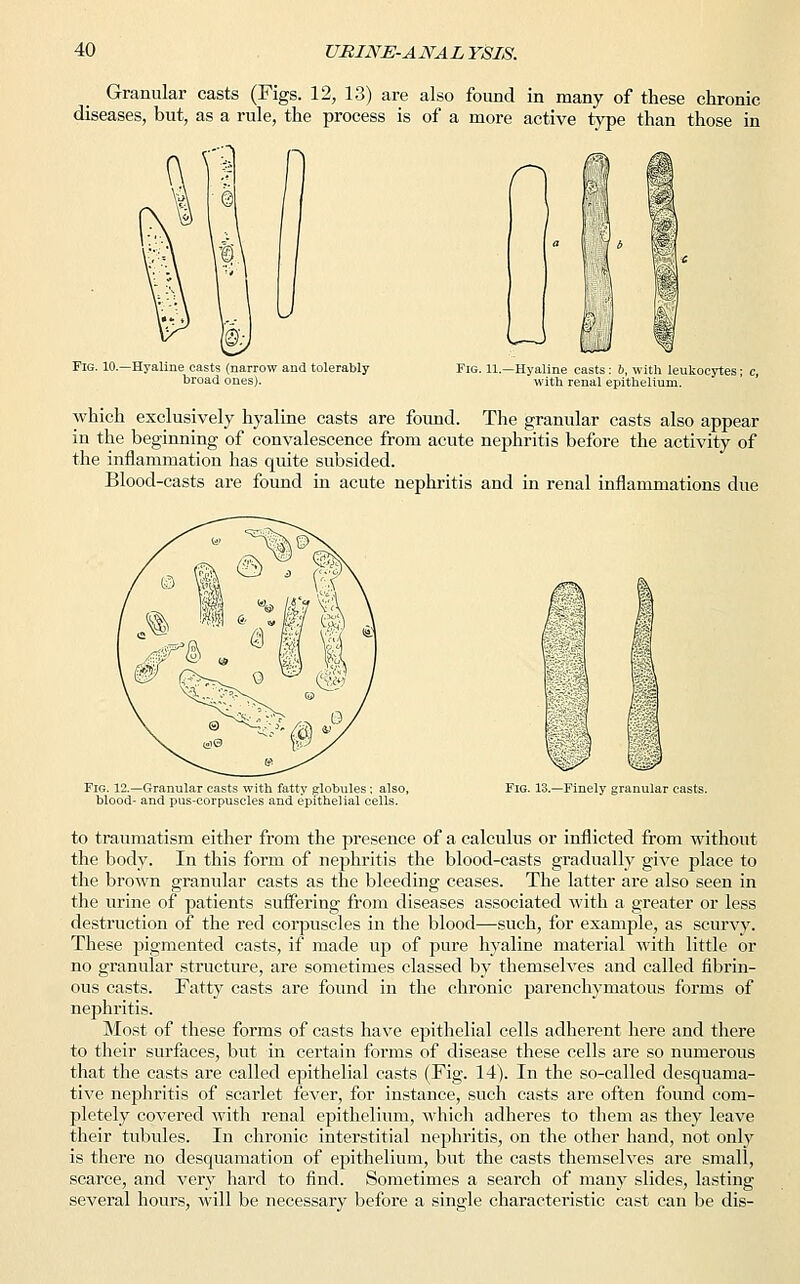 Granular casts (Figs. 12, 13) are also found in many of these chronic diseases, but, as a rule, the process is of a more active type than those in Fig. 10.—Hyaline casts (narrow and tolerably broad ones). Fig. 11.—Hyaline casts: b, with leukocytes; with renal epithelium. which exclusively hyaline casts are found. The granular casts also appear in the beginning of convalescence from acute nephritis before the activity of the inflammation has quite subsided. Blood-casts are found in acute nephritis and in renal inflammations due Fig. 12.—Granular casts with fatty globules; also, blood- and pus-corpuscles and epithelial cells. Fig. 13.—Finely granular casts. to traumatism either from the presence of a calculus or inflicted from without the body. In this form of nephritis the blood-casts gradually give place to the brown granular casts as the bleeding ceases. The latter are also seen in the urine of patients suffering from diseases associated with a greater or less destruction of the red corpuscles in the blood—such, for example, as scurvy. These pigmented casts, if made up of pure hyaline material with little or no granular structure, are sometimes classed by themselves and called fibrin- ous casts. Fatty casts are found in the chronic parenchymatous forms of nephritis. Most of these forms of casts have epithelial cells adherent here and there to their surfaces, but in certain forms of disease these cells are so numerous that the casts are called epithelial casts (Fig. 14). In the so-called desquama- tive nephritis of scarlet fever, for instance, such casts are often found com- pletely covered with renal epithelium, which adheres to them as they leave their tubules. In chronic interstitial nephritis, on the other hand, not only is there no desquamation of epithelium, but the casts themselves are small, scarce, and very hard to find. Sometimes a search of many slides, lasting several hours, will be necessary before a single characteristic cast can be dis-