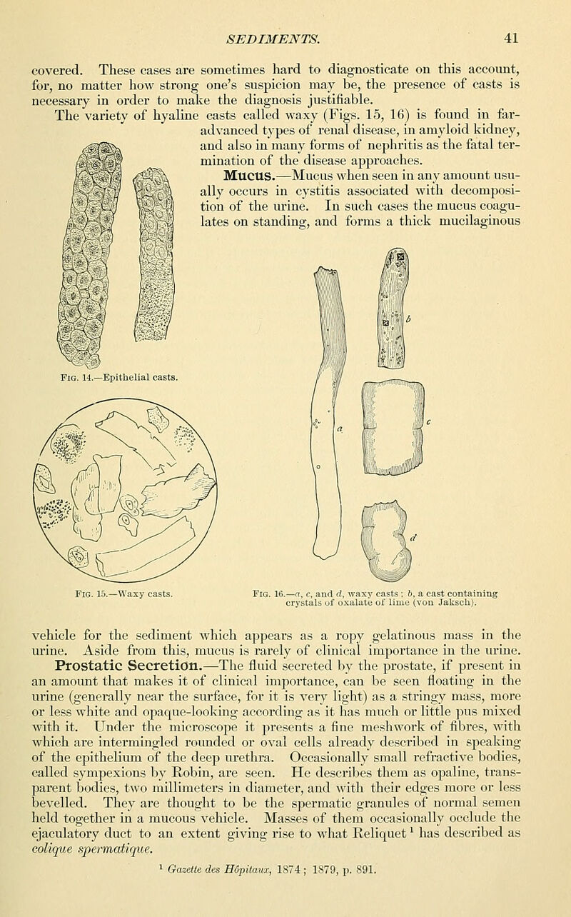 covered. These cases are sometimes hard to diagnosticate on this account, for, no matter how strong one's suspicion may be, the presence of casts is necessary in order to make the diagnosis justifiable. The variety of hyaline casts called waxy (Figs. 15, 16) is found in far- advanced types of renal disease, in amyloid kidney, and also in many forms of nephritis as the fatal ter- mination of the disease approaches. MUCUS.—Mucus when seen in any amount usu- ally occurs in cystitis associated with decomposi- tion of the urine. In such cases the mucus coagu- lates on standing, and forms a thick mucilaginous Fig. 15.—Waxy casts. Fig. 16.—a -a, c, and d, waxy casts : b, a cast containing irystals of oxalate of lime (von Jaksch). vehicle for the sediment which appears as a ropy gelatinous mass in the urine. Aside from this, mucus is rarely of clinical importance in the urine. Prostatic Secretion.—The fluid secreted by the prostate, if present in an amount that makes it of clinical importance, can be seen floating in the urine (generally near the surface, for it is very light) as a stringy mass, more or less white and opaque-looking according as it has much or little pus mixed with it. Under the microscope it presents a fine meshwork of fibres, with which are intermingled rounded or oval cells already described in speaking of the epithelium of the deep urethra. Occasionally small refractive bodies, called sympexions by Robin, are seen. He describes them as opaline, trans- parent bodies, two millimeters in diameter, and with their edges more or less bevelled. They are thought to be the spermatic granules of normal semen held together in a mucous vehicle. Masses of them occasionally occlude the ejaculatory duct to an extent giving rise to what Reliquetl has described as colique spermatique. 1 Gazette des Hopitaux, 1874 ; 1879, p. 891.