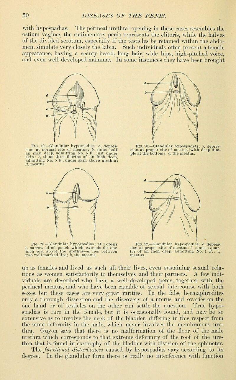 with hypospadias. The perineal urethral opening in these cases resembles the ostium vaginas, the rudimentary penis represents the clitoris, while the halves of the divided scrotum, especially if the testicles be retained within the abdo- men, simulate very closely the labia. Such individuals often present a female appearance, having a scanty beard, long hair, wide hips, high-pitched voice, and even well-developed mammae. In some instances they have been brought Fig. 19.—Glandular hypospadias: a, depres- sion at normal site of meatus; 6, sinus half an inch deep, admitting No. 5 F., just under skin: c, sinus three-fourths of an inch deep, admitting No. 5 F., under skin above urethra; dy meatus. Fig. 20.—Glandular hypospadias: a, depres- sion at proper site of meatus (with deep dim- ple at the bottom); 6, the meatus. Fig. 21.—Glandular hypospadias : at a opens a narrow blind pouch which extends for one inch just above the urethra—a, lies between two well-marked lips; b, the meatus. Fig. 22.—Glandular hypospadias: a, depres- sion at proper site of meatus; b, sinus a quar- ter of an inch deep, admitting No. 1 F.; c, meatus. up as females and lived as such all their lives, even sustaining sexual rela- tions as women satisfactorily to themselves and their partners. A few indi- viduals are described who have a well-developed penis, together with the perineal meatus, and who have been capable of sexual intercourse with both sexes, but these cases are very great rarities. In the false hermaphrodites only a thorough dissection and the discovery of a uterus and ovaries on the one hand or of testicles on the other can settle the question. True hypo- spadias is rare in the female, but it is occasionally found, and may be so extensive as to involve the neck of the bladder, differing in this respect from the same deformity in the male, which never involves the membranous ure- thra. Guyon says that there is no malformation of the floor of the male urethra which corresponds to that extreme deformity of the roof of the ure- thra that is found in exstrophy of the bladder with division of the sphincter. The functional disturbances caused by hypospadias vary according to its degree. In the glandular form there is really no-interference with function