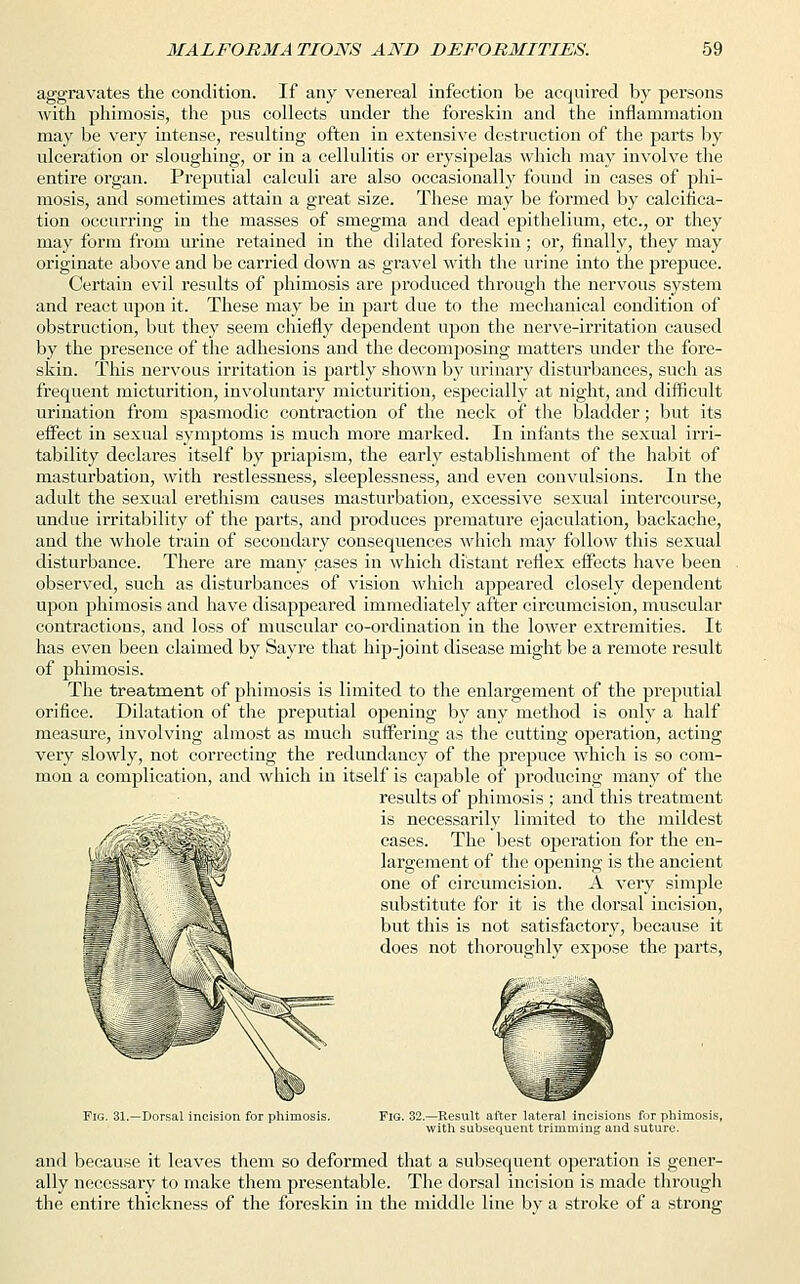 aggravates the condition. If any venereal infection be acquired by persons with phimosis, the pus collects under the foreskin and the inflammation may be very intense, resulting often in extensive destruction of the parts by ulceration or sloughing, or in a cellulitis or erysipelas which may involve the entire organ. Preputial calculi are also occasionally found in cases of phi- mosis, and sometimes attain a great size. These may be formed by calcifica- tion occurring in the masses of smegma and dead epithelium, etc., or they may form from urine retained in the dilated foreskin; or, finally, they may originate above and be carried down as gravel with the urine into the prepuce. Certain evil results of phimosis are produced through the nervous system and react upon it. These may be hi part due to the mechanical condition of obstruction, but they seem chiefly dependent upon the nerve-irritation caused by the presence of the adhesions and the decomposing matters under the fore- skin. This nervous irritation is partly shown by urinary disturbances, such as frequent micturition, involuntary micturition, especially at night, and difficult urination from spasmodic contraction of the neck of the bladder; but its effect in sexual symptoms is much more marked. In infants the sexual irri- tability declares itself by priapism, the early establishment of the habit of masturbation, with restlessness, sleeplessness, and even convulsions. In the adult the sexual erethism causes masturbation, excessive sexual intercourse, undue irritability of the parts, and produces premature ejaculation, backache, and the whole train of secondary consequences which may follow this sexual disturbance. There are many cases in which distant reflex effects have been observed, such as disturbances of vision which appeared closely dependent upon phimosis and have disappeared immediately after circumcision, muscular contractions, and loss of muscular co-ordination in the lower extremities. It has even been claimed by Sayre that hip-joint disease might be a remote result of phimosis. The treatment of phimosis is limited to the enlargement of the preputial orifice. Dilatation of the preputial opening by any method is only a half measure, involving almost as much suffering as the cutting operation, acting very slowly, not correcting the redundancy of the prepuce which is so com- mon a complication, and which in itself is capable of producing many of the results of phimosis ; and this treatment is necessarily limited to the mildest cases. The best operation for the en- largement of the opening is the ancient one of circumcision. A very simple substitute for it is the dorsal incision, but this is not satisfactory, because it does not thoroughly expose the parts, Fig. 31.—Dorsal incision for ph Fig. 32.—Result after lateral incisions for phimosis, with subsequent trimming and suture. and because it leaves them so deformed that a subsequent operation is gener- ally necessary to make them presentable. The dorsal incision is made through the entire thickness of the foreskin in the middle line by a stroke of a strong