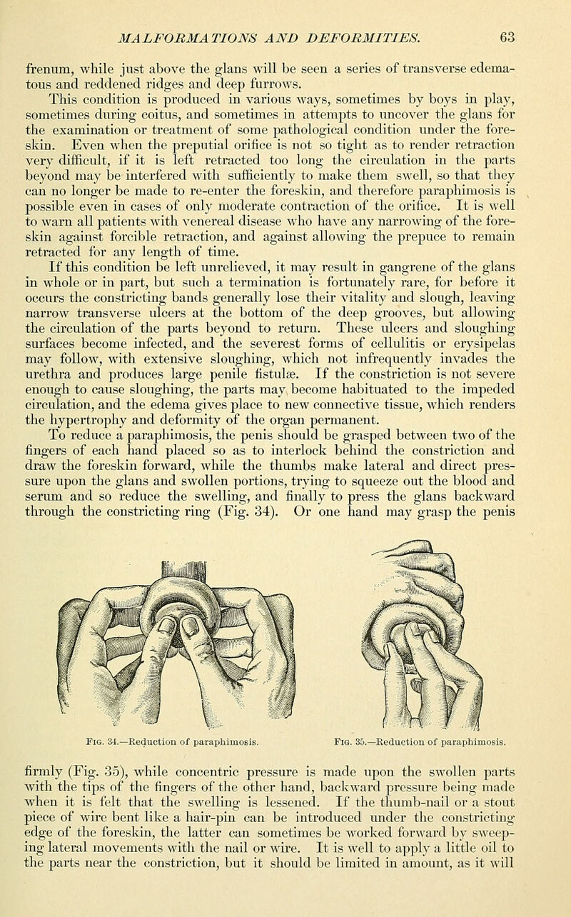 frenum, while just above the glans will be seen a series of transverse edema- tous and reddened ridges and deep furrows. This condition is produced in various ways, sometimes by boys in play, sometimes during coitus, and sometimes in attempts to uncover the glans for the examination or treatment of some pathological condition under the fore- skin. Even when the preputial orifice is not so tight as to render retraction very difficult, if it is left retracted too long the circulation in the parts beyond may be interfered with sufficiently to make them swell, so that they can no longer be made to re-enter the foreskin, and therefore paraphimosis is possible even in cases of only moderate contraction of the orifice. It is well to warn all patients with venereal disease who have any narrowing of the fore- skin against forcible retraction, and against allowing the prepuce to remain retracted for any length of time. If this condition be left unrelieved, it may result in gangrene of the glans in whole or in part, but such a termination is fortunately rare, for before it occurs the constricting bands generally lose their vitality and slough, leaving narrow transverse ulcers at the bottom of the deep grooves, but allowing the circulation of the parts beyond to return. These ulcers and sloughing surfaces become infected, and the severest forms of cellulitis or erysipelas may follow, with extensive sloughing, which not infrequently invades the urethra and produces large penile fistulse. If the constriction is not severe enough to cause sloughing, the parts may become habituated to the impeded circulation, and the edema gives place to new connective tissue, which renders the hypertrophy and deformity of the organ permanent. To reduce a paraphimosis, the penis should be grasped between two of the fingers of each hand placed so as to interlock behind the constriction and draw the foreskin forward, while the thumbs make lateral and direct pres- sure upon the glans and swollen portions, trying to squeeze out the blood and serum and so reduce the swelling, and finally to press the glans backward through the constricting ring (Fig. 34). Or one hand may grasp the penis Fig. 34.—Reduction of paraphimosis. Fig. 35.—Reduction of paraphimosis. firmly (Fig. 35), while concentric pressure is made upon the swollen parts with the tips of the fingers of the other hand, backward pressure being made when it is felt that the swelling is lessened. If the thumb-nail or a stout piece of wire bent like a hair-pin can be introduced under the constricting edge of the foreskin, the latter can sometimes be worked forward by sweep- ing lateral movements with the nail or wire. It is well to apply a little oil to the parts near the constriction, but it should be limited in amount, as it will