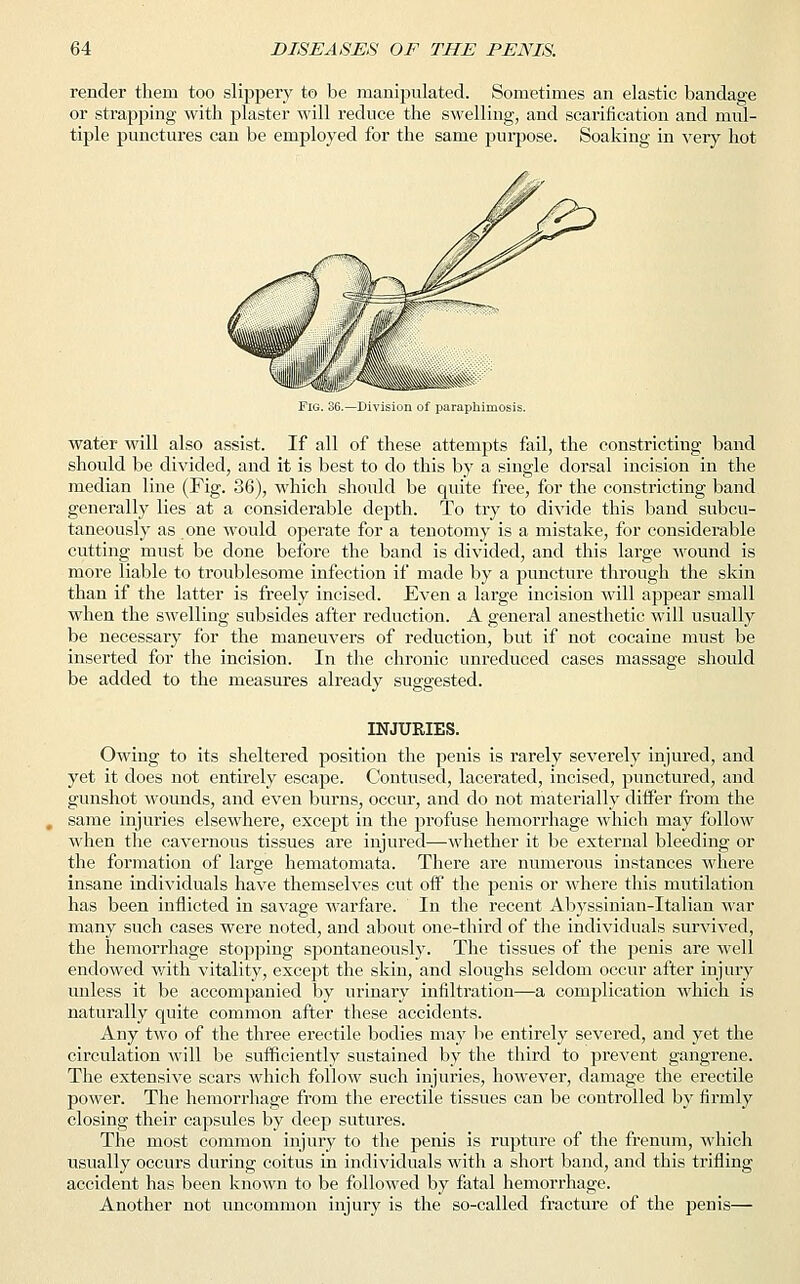 render them too slippery to be manipulated. Sometimes an elastic bandage or strapping with plaster will reduce the swelling, and scarification and mul- tiple punctures can be employed for the same purpose. Soaking in very hot Fig. 36.—Division of paraphimosis. water will also assist. If all of these attempts fail, the constricting band should be divided, and it is best to do this by a single dorsal incision in the median line (Fig. 36), which should be quite free, for the constricting band generally lies at a considerable depth. To try to divide this band subcu- taneously as one would operate for a tenotomy is a mistake, for considerable cutting must be done before the band is divided, and this large wound is more liable to troublesome infection if made by a puncture through the skin than if the latter is freely incised. Even a large incision will appear small when the swelling subsides after reduction. A general anesthetic will usually be necessary for the maneuvers of reduction, but if not cocaine must be inserted for the incision. In the chronic unreduced cases massage should be added to the measures already suggested. INJURIES. Owing to its sheltered position the penis is rarely severely injured, and yet it does not entirely escape. Contused, lacerated, incised, punctured, and gunshot wounds, and even burns, occur, and do not materially differ from the same injuries elsewhere, except in the profuse hemorrhage which may follow when the cavernous tissues are injured—whether it be external bleeding or the formation of large hematomata. There are numerous instances where insane individuals have themselves cut off the penis or where this mutilation has been inflicted in savage warfare. In the recent Abyssinian-Italian war many such cases were noted, and about one-third of the individuals survived, the hemorrhage stopping spontaneously. The tissues of the penis are well endowed with vitality, except the skin, and sloughs seldom occur after injury unless it be accompanied by urinary infiltration—a complication which is naturally quite common after these accidents. Any two of the three erectile bodies may be entirely severed, and yet the circulation will be sufficiently sustained by the third to prevent gangrene. The extensive scars which follow such injuries, however, damage the erectile power. The hemorrhage from the erectile tissues can be controlled by firmly closing their capsules by deep sutures. The most common injury to the penis is rupture of the frenum, which usually occurs during coitus in individuals with a short band, and this trifling accident has been known to be followed by fatal hemorrhage. Another not uncommon injury is the so-called fracture of the penis—