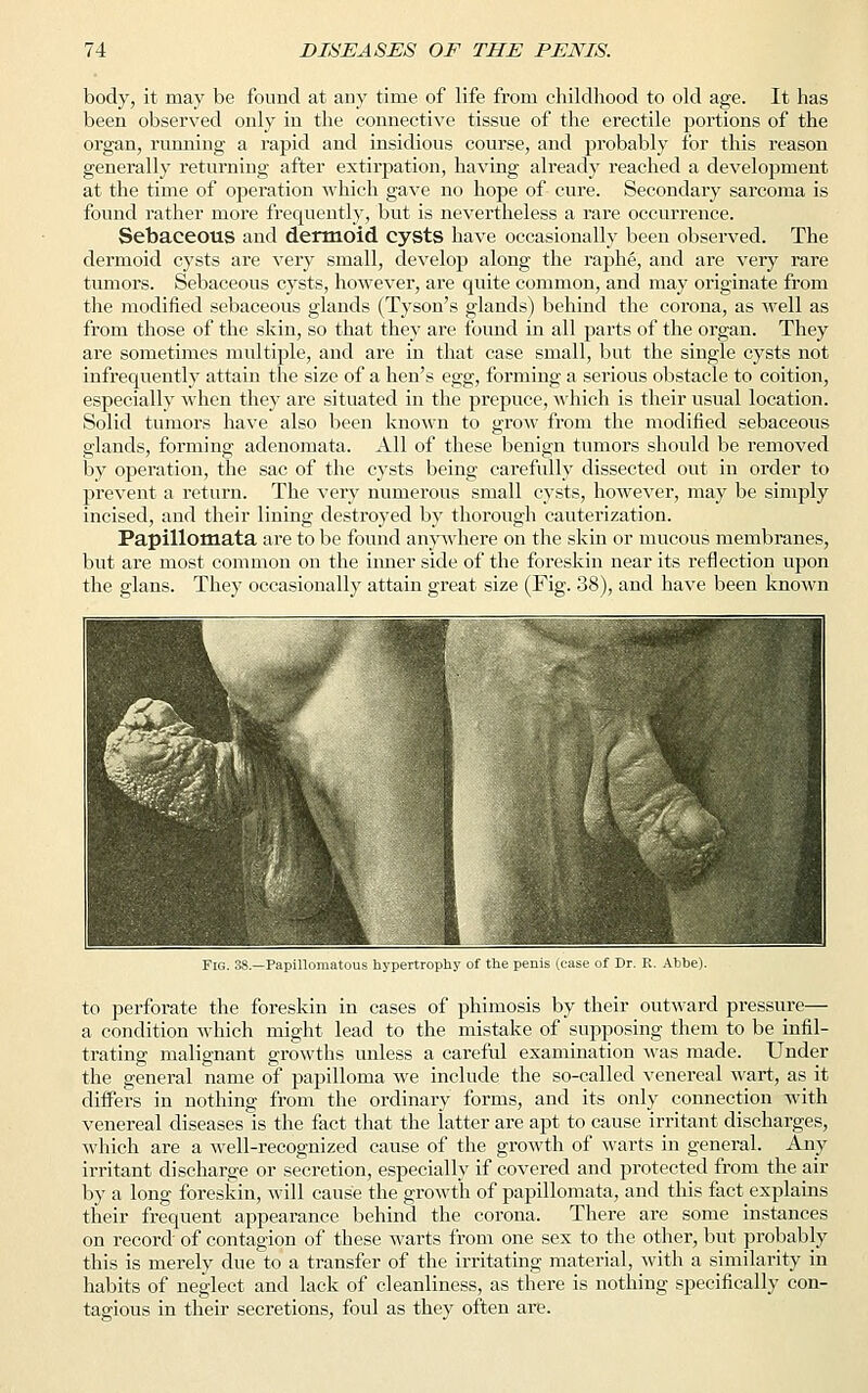 body, it may be found at any time of life from childhood to old age. It has been observed only in the connective tissue of the erectile portions of the organ, running a rapid and insidious course, and probably for this reason generally returning after extirpation, having already reached a development at the time of operation which gave no hope of cure. Secondary sarcoma is found rather more frequently, but is nevertheless a rare occurrence. Sebaceous and dermoid cysts have occasionally been observed. The dermoid cysts are very small, develop along the raphe, and are very rare tumors. Sebaceous cysts, however, are quite common, and may originate from the modified sebaceous glands (Tyson's glands) behind the corona, as well as from those of the skin, so that they are found in all parts of the organ. They are sometimes multiple, and are in that case small, but the single cysts not infrequently attain the size of a hen's egg, forming a serious obstacle to coition, especially when they are situated in the prepuce, which is their usual location. Solid tumors have also been known to grow from the modified sebaceous glands, forming adenomata. All of these benign tumors should be removed by operation, the sac of the cysts being carefully dissected out in order to prevent a return. The very numerous small cysts, however, may be simply incised, and their lining destroyed by thorough cauterization. Papillomata are to be found anywhere on the skin or mucous membranes, but are most common on the inner side of the foreskin near its reflection upon the glans. They occasionally attain great size (Fig. 38), and have been known Fig. 38.—Papillomatous hypertrophy of the penis (ease of Dr. E. Abhe). to perforate the foreskin in cases of phimosis by their outward pressure— a condition which might lead to the mistake of supposing them to be infil- trating malignant growths unless a careful examination was made. Under the general name of papilloma we include the so-called venereal wart, as it differs in nothing from the ordinary forms, and its only connection with venereal diseases is the fact that the latter are apt to cause irritant discharges, which are a well-recognized cause of the growth of warts in general. Any irritant discharge or secretion, especially if covered and protected from the air by a long foreskin, will cause the growth of papillomata, and this fact explains their frequent appearance behind the corona. There are some instances on record of contagion of these warts from one sex to the other, but probably this is merely due to a transfer of the irritating material, with a similarity in habits of neglect and lack of cleanliness, as there is nothing specifically con- tagious in their secretions, foul as they often are.