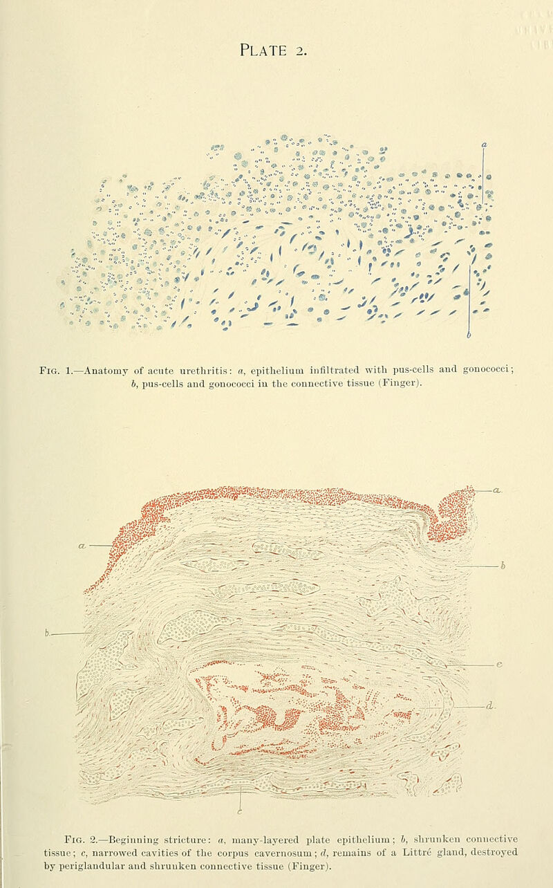 Plate 2. ■ ?« »■■■■ «•■• >: Fig. 1.—Anatomy of acute urethritis: a, epithelium infiltrated with pus-cells and gonococci; b, pus-cells and gonococci in the connective tissue (Finger). Ifew Fig. 2.—Beginning stricture: a, many-layered plate epithelium; b, shrunken connective tissue; c, narrowed cavities of the corpus cavernosum; d. remains of a Littre gland, destroyed by periglandular and shrunken connective tissue (Finger).