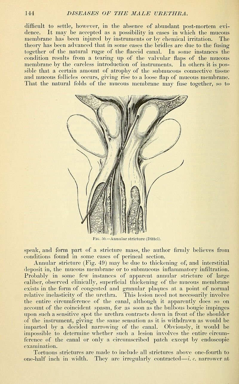 difficult to settle, however, in the absence of abundant post-mortem evi- dence. It may be accepted as a possibility in cases in which the mucous membrane has been injured by instruments or by chemical irritation. The theory has been advanced that in some cases the bridles are due to the fusing together of the natural rugas of the flaccid canal. In some instances the condition results from a tearing up of the valvular flaps of the mucous membrane by the careless introduction of instruments. In others it is pos- sible that a certain amount of atrophy of the submucous connective tissue and mucous follicles occurs, giving rise to a loose flap of mucous membrane. That the natural folds of the mucous membrane may fuse together, so to Fig. 50.—Annular stricture (Dittel). speak, and form part of a stricture mass, the author firmly believes from conditions found in some cases of perineal section. Annular stricture (Fig. 49) may be due to thickening of, and interstitial deposit in, the mucous membrane or to submucous inflammatory infiltration. Probably in some few instances of apparent annular stricture of large caliber, observed clinically, superficial thickening of the mucous membrane exists in the form of congested and granular plaques at a point of normal relative inelasticity of the urethra. This lesion need not necessarily involve the entire circumference of the canal, although it apparently does so on account of the coincident spasm, for as soon as the bulbous bougie impinges upon such a sensitive spot the urethra contracts down in front of the shoulder of the instrument, giving the same sensation as it is withdrawn as would be imparted by a decided narrowing of the canal. Obviously, it would be impossible to determine whether such a lesion involves the entire circum- ference of the canal or only a circumscribed patch except by endoscopic examination. Tortuous strictures are made to include all strictures above one-fourth to one-half inch in width. They are irregularly contracted—i. e. narrower at