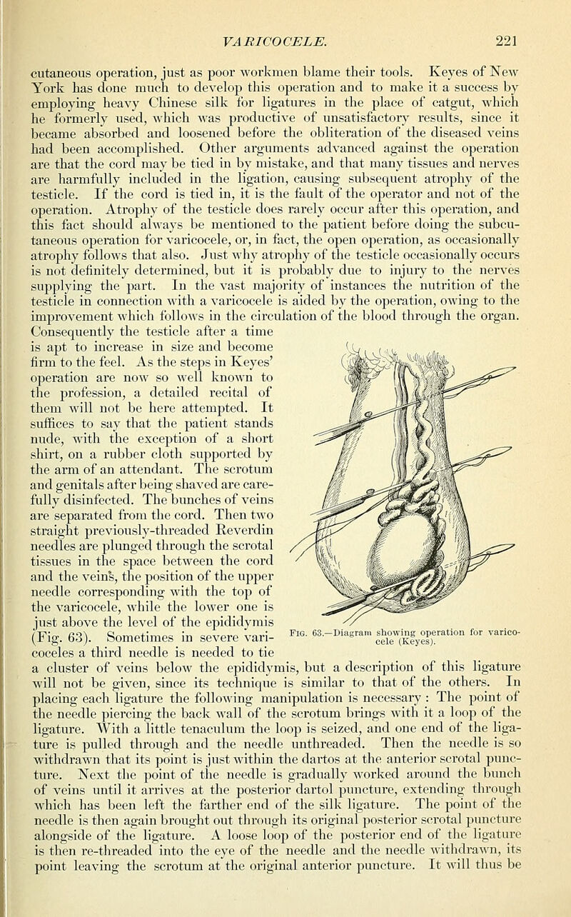 cutaneous operation, just as poor workmen blame their tools. Keyes of New York has done much to develop this operation and to make it a success by employing heavy Chinese silk tor ligatures in the place of catgut, which he formerly used, which M'as productive of unsatisfactory results, since it became absorbed and loosened before the obliteration of the diseased veins had been accomplished. Other arguments advanced against the operation are that the cord may be tied in by mistake, and that many tissues and nerves are harmfully included in the ligation, causing subsequent atrophy of the testicle. If the cord is tied in, it is the fault of the operator and not of the operation. Atrophy of the testicle does rarely occur after this operation, and this fact should always be mentioned to the patient before doing the subcu- taneous operation for varicocele, or, in fact, the open operation, as occasionally atrophy follows that also. Just why atrophy of the testicle occasionally occurs is not definitely determined, but it is probably due to injury to the nerves supplying the part. In the vast majority of instances the nutrition of the testicle in connection with a varicocele is aided by the operation, owing to the improvement which follows in the circulation of the blood through the organ. Consequently the testicle after a time is apt to increase in size and become firm to the feel. As the steps in Keyes' operation are now so well known to the profession, a detailed recital of them will not be here attempted. It suffices to say that the patient stands nude, with the exception of a short shirt, on a rubber cloth supported by the arm of an attendant. The scrotum and genitals after being shaved are care- fully disinfected. The bunches of veins are separated from the cord. Then two straight previously-threaded Reverdin needles are plunged through the scrotal tissues in the space between the cord and the vein's, the position of the upper needle corresponding with the top of the varicocele, while the lower one is just above the level of the epididymis (Fig. 63). Sometimes in severe vari- coceles a third needle is needed to tie a cluster of veins below the epididymis, but a description of this ligature will not be given, since its technique is similar to that of the others. In placing each ligature the following manipulation is necessary : The point of the needle piercing the back wall of the scrotum brings with it a loop of the ligature. With a little tenaculum the loop is seized, and one end of the liga- ture is pulled through and the needle unthreaded. Then the needle is so withdrawn that its point is just within the dartos at the anterior scrotal punc- ture. Next the point of the needle is gradually worked around the bunch of veins until it arrives at the posterior dartol puncture, extending through which has been left the farther end of the silk ligature. The point of the needle is then again brought out through its original posterior scrotal puncture alongside of the ligature. A loose loop of the posterior end of the ligature is then re-threaded into the eye of the needle and the needle withdrawn, its point leaving the scrotum at the original anterior puncture. It will thus be -Diagram showing operation for varico- cele (Keyes).