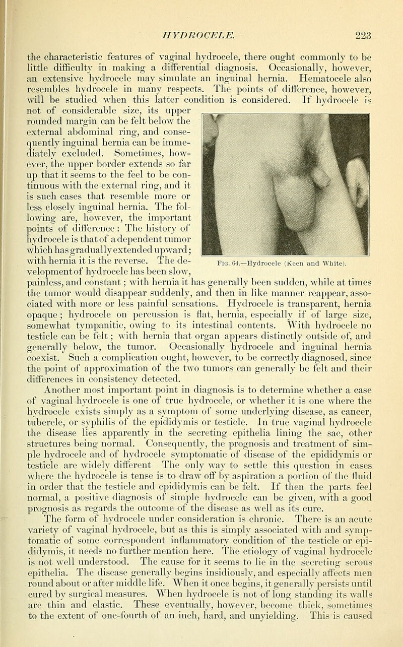 Fig. 64.—Hydrocele (Keen and White). the characteristic features of vaginal hydrocele, there ought commonly to be little difficulty in making a differential diagnosis. Occasionally, however, an extensive hydrocele may simulate an inguinal hernia. Hematocele also resembles hydrocele in many respects. The points of difference, however, will be studied when this latter condition is considered. If hydrocele is not of considerable size, its upper rounded margin can be felt below the external abdominal ring, and conse- quently inguinal hernia can be imme- diately excluded. Sometimes, how- ever, the upper border extends so far up that it seems to the feel to be con- tinuous with the external ring, and it is such cases that resemble more or less closely inguinal hernia. The fol- lowing are, however, the important points of difference : The history of hydrocele is that of a dependent tumor which has gradually extended upward; with hernia it is the reverse. The de- velopment of hydrocele has been slow, painless, and constant; with hernia it has generally been sudden, while at times the tumor would disappear suddenly, and then in like manner reappear, asso- ciated with more or less painful sensations. Hydrocele is transparent, hernia opaque; hydrocele on percussion is flat, hernia, especially if of large size, somewhat tympanitic, owing to its intestinal contents. With hydrocele no testicle can be felt; with hernia that organ appears distinctly outside of, and generally below, the tumor. Occasionally hydrocele and inguinal hernia coexist. Such a complication ought, however, to be correctly diagnosed, since the point of approximation of the two tumors can generally be felt and their differences in consistency detected. Another most important point in diagnosis is to determine whether a case of vaginal hydrocele is one of true hydrocele, or whether it is one where the hydrocele exists simply as a symptom of some underlying disease, as cancer, tubercle, or syphilis of the epididymis or testicle. In true vaginal hydrocele the disease lies apparently in the secreting epithelia lining the sac, other structures being normal. Consequently, the prognosis and treatment of sim- ple hydrocele and of hydrocele symptomatic of disease of the epididymis or testicle are widely different The only way to settle this question in cases where the hydrocele is tense is to draw off by aspiration a portion of the fluid in order that the testicle and epididymis can be felt. If then the parts feel normal, a positive diagnosis of simple hydrocele can be given, with a good prognosis as regards the outcome of the disease as well as its cure. The form of hydrocele under consideration is chronic. There is an acute variety of vaginal hydrocele, but as this is simply associated with and symp- tomatic of some correspondent inflammatory condition of the testicle or epi- didymis, it needs no further mention here. The etiology of vaginal hydrocele is not well understood. The cause for it seems to lie in the secreting serous epithelia. The disease generally begins insidiously, and especially affects men round about or after middle life. When it once begins, it generally persists until cured by surgical measures. When hydrocele is not of long standing its walls are thin and elastic. These eventually, however, become thick, sometimes to the extent of one-foui'th of an inch, hard, and unyielding. This is caused