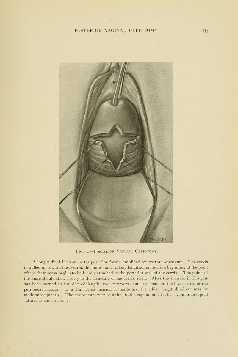 Fig. I.—Posterior Vaginal Celiotomy. A longitudinal incision in the posterior fornix amplified by two transverse cuts. The cervix is pulled up toward theurethra, the knife makes a long longitudinal incision beginning at the point where themucosa begins to be loosely attached to the posterior wall of the cervix. The point of the knife should stick closely to the structure of the cervix itself. After the incision in Douglas has been carried to the desired length, two transverse cuts are made at the lowest area of the peritoneal incision. If a transverse incision is made first the added longitudinal cut may be made subsequently. The peritoneum may be united to the vaginal mucosa by several interrupted sutures as shown above.