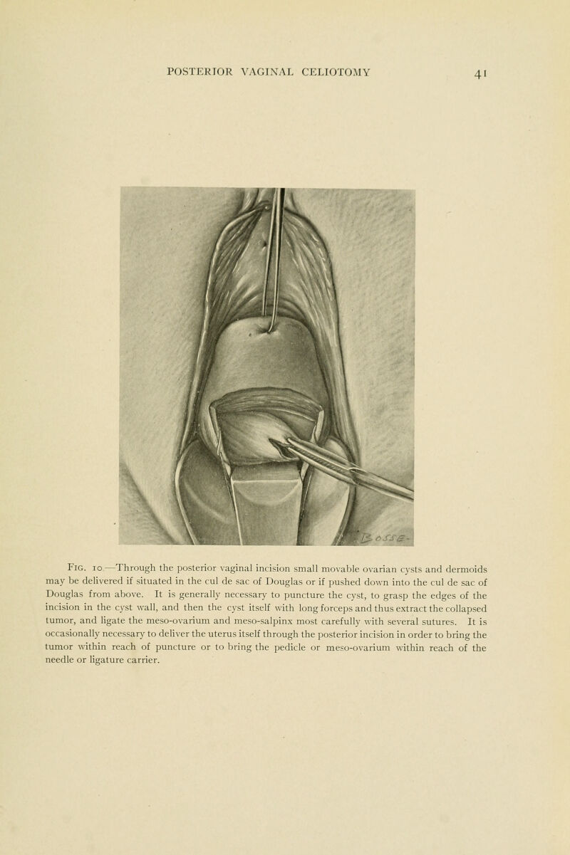 Fig. 10.—Through the posterior vaginal incision small movable ovarian cysts and dermoids may be delivered if situated in the cul de sac of Douglas or if pushed down into the cul de sac of Douglas from above. It is generally necessary to puncture the cyst, to grasp the edges of the incision in the cyst vi^all, and then the cyst itself with long forceps and thus extract the collapsed tumor, and ligate the meso-ovarium and meso-salpinx most carefully with several sutures. It is occasionally necessary to deliver the uterus itself through the posterior incision in order to bring the tumor within reach of puncture or to bring the pedicle or meso-ovarium within reach of the needle or ligature carrier.