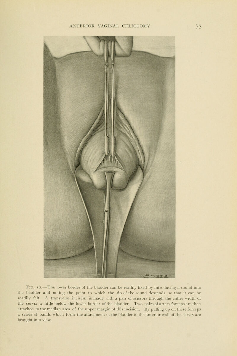 ■ f'-^SKfeS^S i Fig. iS.—The lower border of the bladder can be readily fixed by introducing a sound into the bladder and noting the point to which the tip of the sound descends, so that it can be readily felt. A transverse incision is made with a pair of scissors through the entire width of the cervix a Uttle below the lower border of the bladder. Two pairs of artery forceps are then attached to the median area of the upper margin of this incision. By pulling up on these forceps a series of bands which form the attachment of the bladder to the anterior wall of the cervix are brought into view.