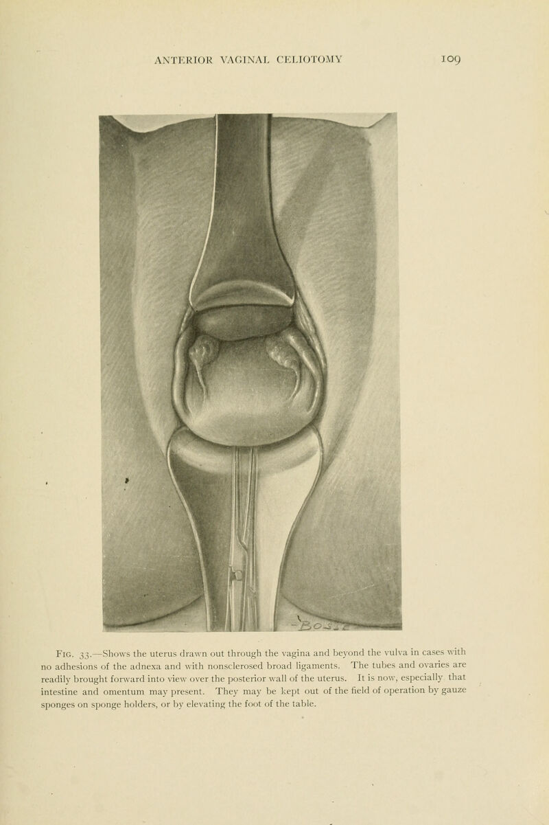 Fig. S3-—Shows the uterus drawn out through the vagina and beyond the vulva in cases with no adhesions of the adnexa and with nonsclerosed broad ligaments. The tubes and ovaries are readily brought forward into view over the posterior wall of the uterus. It is now, especially that intestine and omentum may present. They may be kept out of the field of operation by gauze sponges on sponge holders, or by elevating the foot of the table.