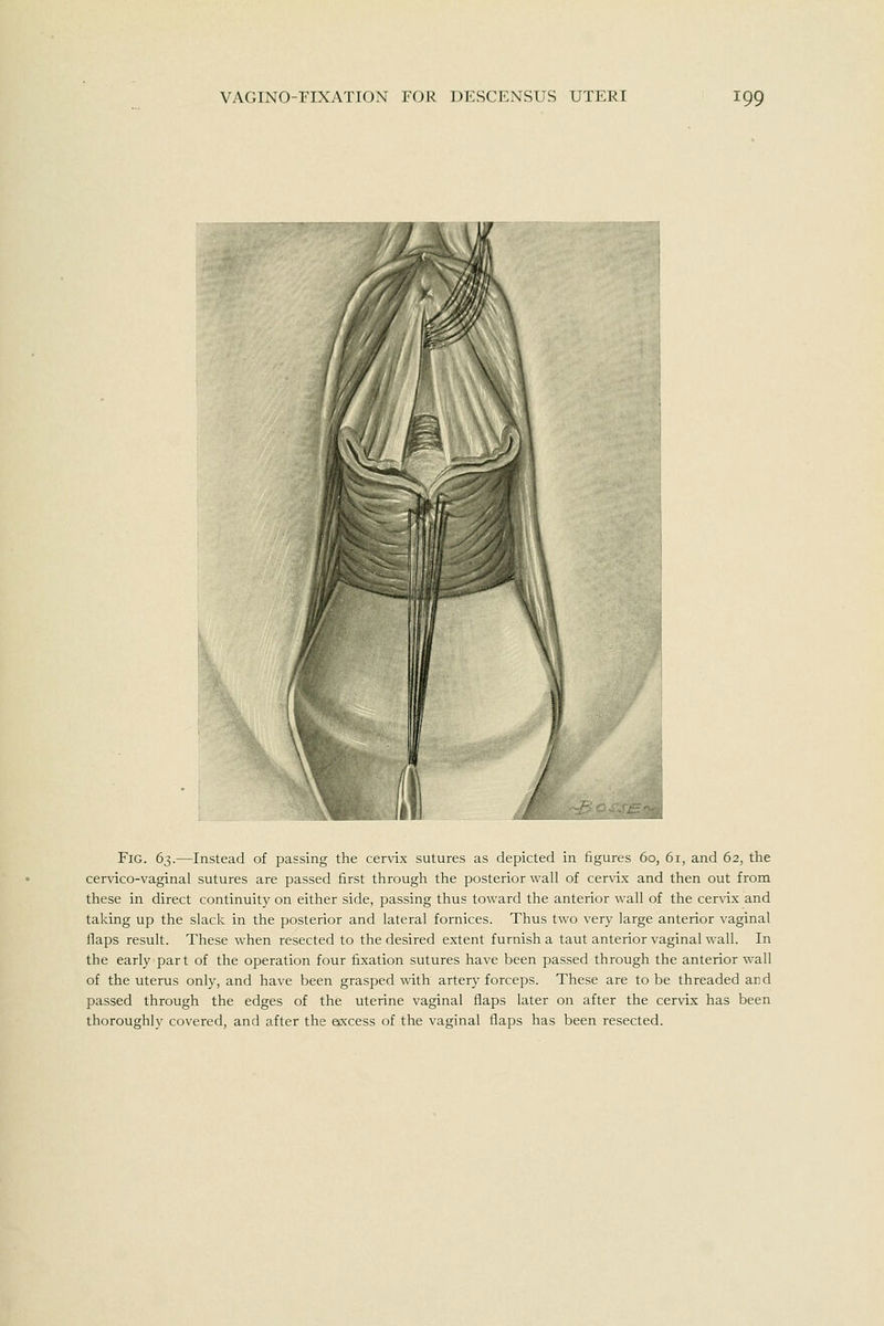 Fig. 63.—Instead of passing the cervix sutures as depicted in figures 60, 61, and 62, the cervico-vaginal sutures are passed first through the posterior wall of cervix and then out from these in direct continuity on either side, passing thus toward the anterior wall of the cervix and taking up the slack in the posterior and lateral fornices. Thus two very large anterior vaginal Haps result. These when resected to the desired extent furnish a taut anterior vaginal wall. In the early part of the operation four fixation sutures have been passed through the anterior wall of the uterus only, and have been grasped with artery forceps. These are to be threaded and passed through the edges of the uterine vaginal flaps later on after the cervix has been thoroughly covered, and after the esxcess of the vaginal flaps has been resected.