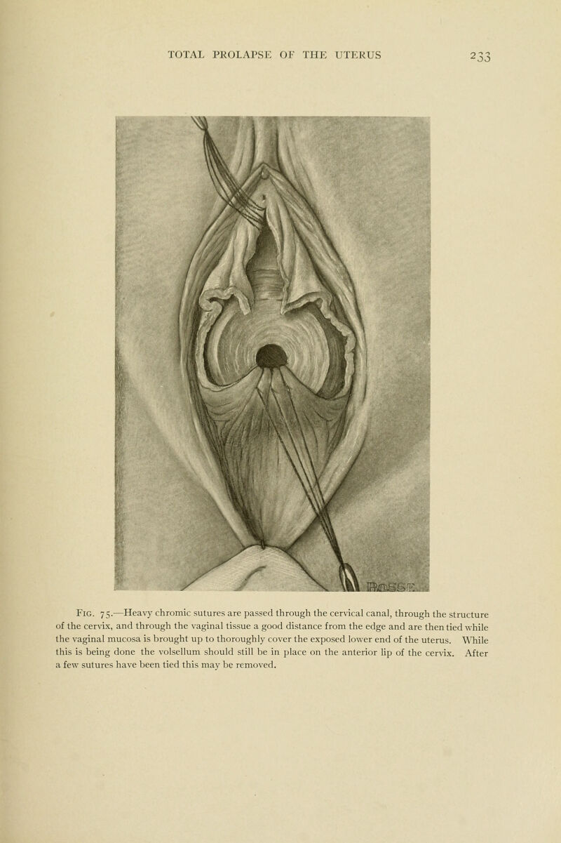 oo Fig. 75.—Heavy chromic sutures are passed through the cervical canal, through the structure of the cervix, and through the vaginal tissue a good distance from the edge and are then tied while the vaginal mucosa is brought up to thoroughly cover the exposed lower end of the uterus. While this is being done the volsellum should still be in place on the anterior lip of the cervix. After a few sutures have been tied this may be removed.