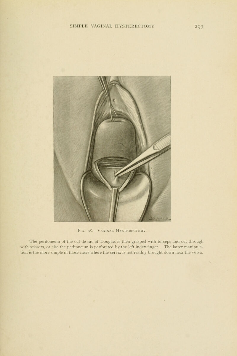 Fig. 98.—\'aginal Hysterectomy. The peritoneum of the cul de sac of Douglas is then grasped with forceps and cut through with scissors, or else the peritoneum is perforated b}' the left index finger. The latter manipula- tion is the more simple in those cases where the cervix is not readily brought down near the vulva.