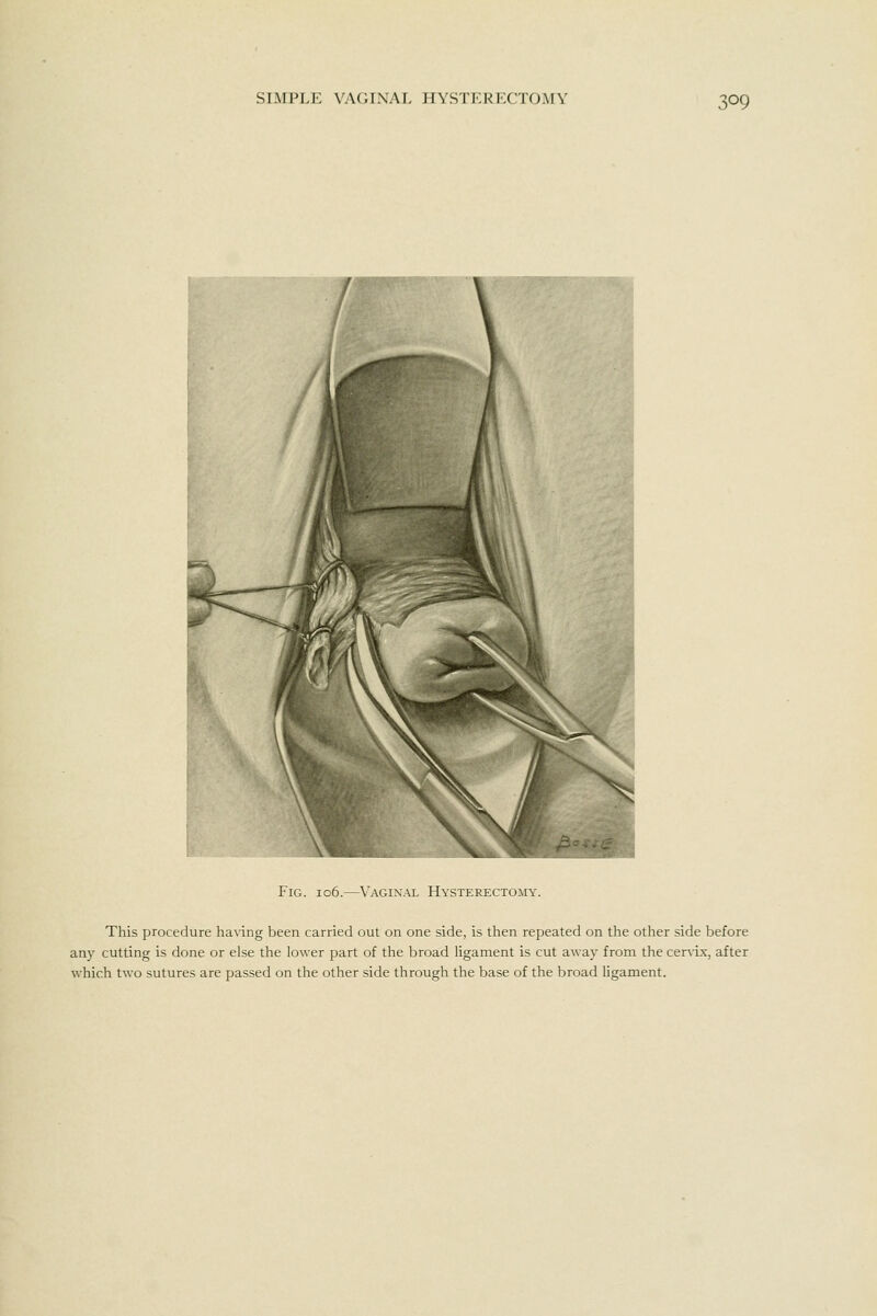 Fig. 106.—^\'AGiNAL Hysterectomy. This procedure having been carried out on one side, is then repeated on the other side before any cutting is done or else the lower part of the broad ligament is cut away from the cer\ix, after which two sutures are passed on the other side through the base of the broad ligament.