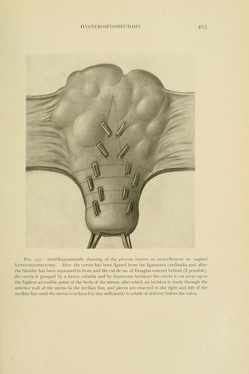 Fig. 137.—Semidiagrammatic drawing of the process known as morcellement in vaginal hysterorayomectomy. After the cervix has been ligated from the hgamenta cardinaUa and after the bladder has been separated in front and the cul de sac of Douglas entered behind (if possible), the cervix is grasped by a heavy volsella and by transverse incisions the cervix is cut away up to the highest accessible point of the body of the uterus, after which an incision is made through the anterior wall of the uterus in the median Une, and pieces are exsected to the right and left of the median line until the uterus is reduced in size sufficientlv to admit of deliverv before the vulva.