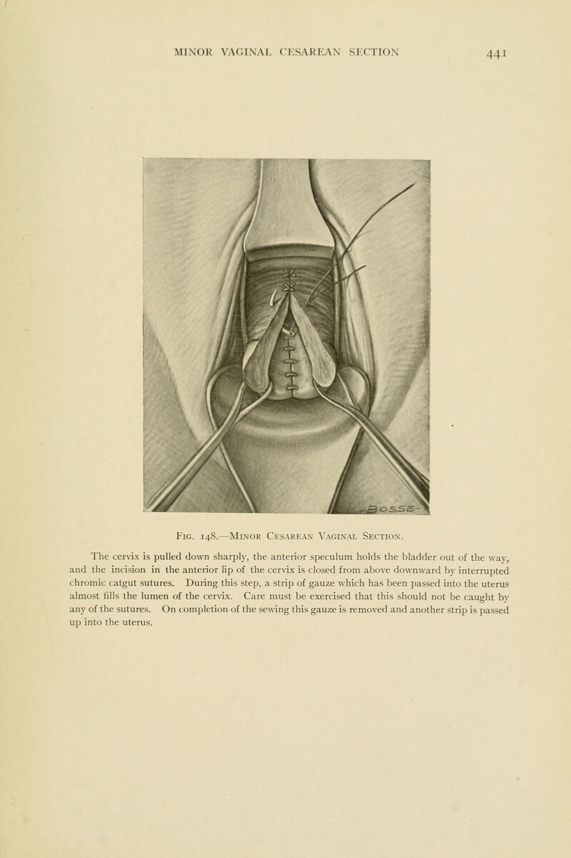 Fig. 148.—Minor Cesarean Vaginal Section. The cervix is pulled down sharply, the anterior speculum holds the bladder out of the wav, and the incision in the anterior lip of the cervix is closed from above downward bj- interrupted chromic catgut sutures. During this step, a strip of gauze which has been passed into the uterus almost fills the lumen of the cervix. Care must be exercised that this should not be caught by any of the sutures. On completion of the sewing this gauze is removed and another strip is passed up into the uterus.