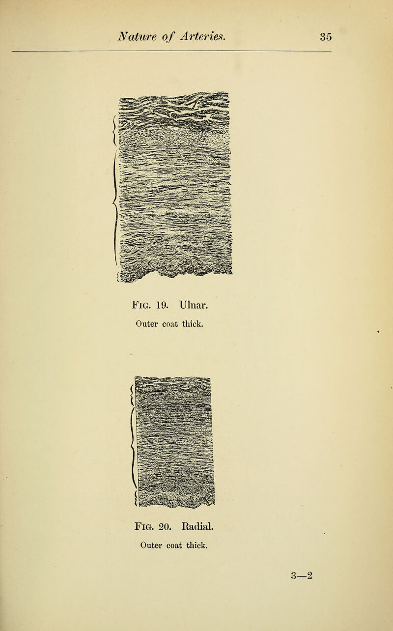 Fig. 19. Ulnar. Outer coat thick. Fig. 20. Radial. Outer coat thick. 3—2