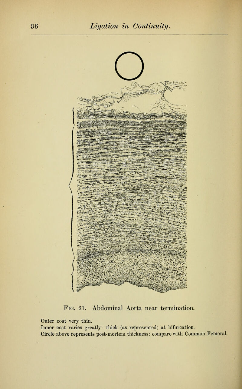 Fig. 21. Abdominal Aorta near termination. Outer coat very thin. Inner coat varies greatly: thick (as represented) at bifurcation. Circle above represents post-mortem thickness: compare with Common Femoral. (