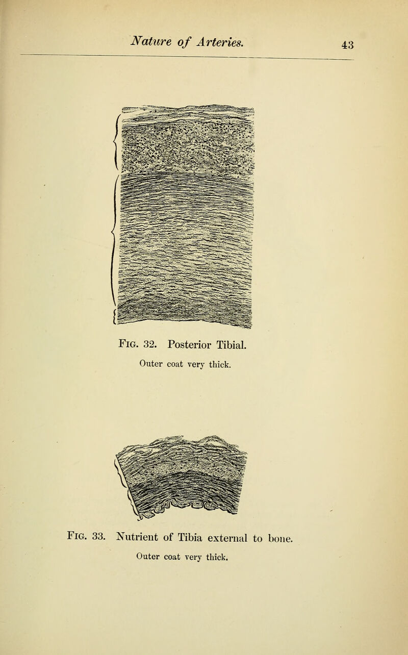 Fig. 32. Posterior Tibial. Outer coat very thick. Fig. 33. Nutrient of Tibia external to bone. Outer coat very thick.