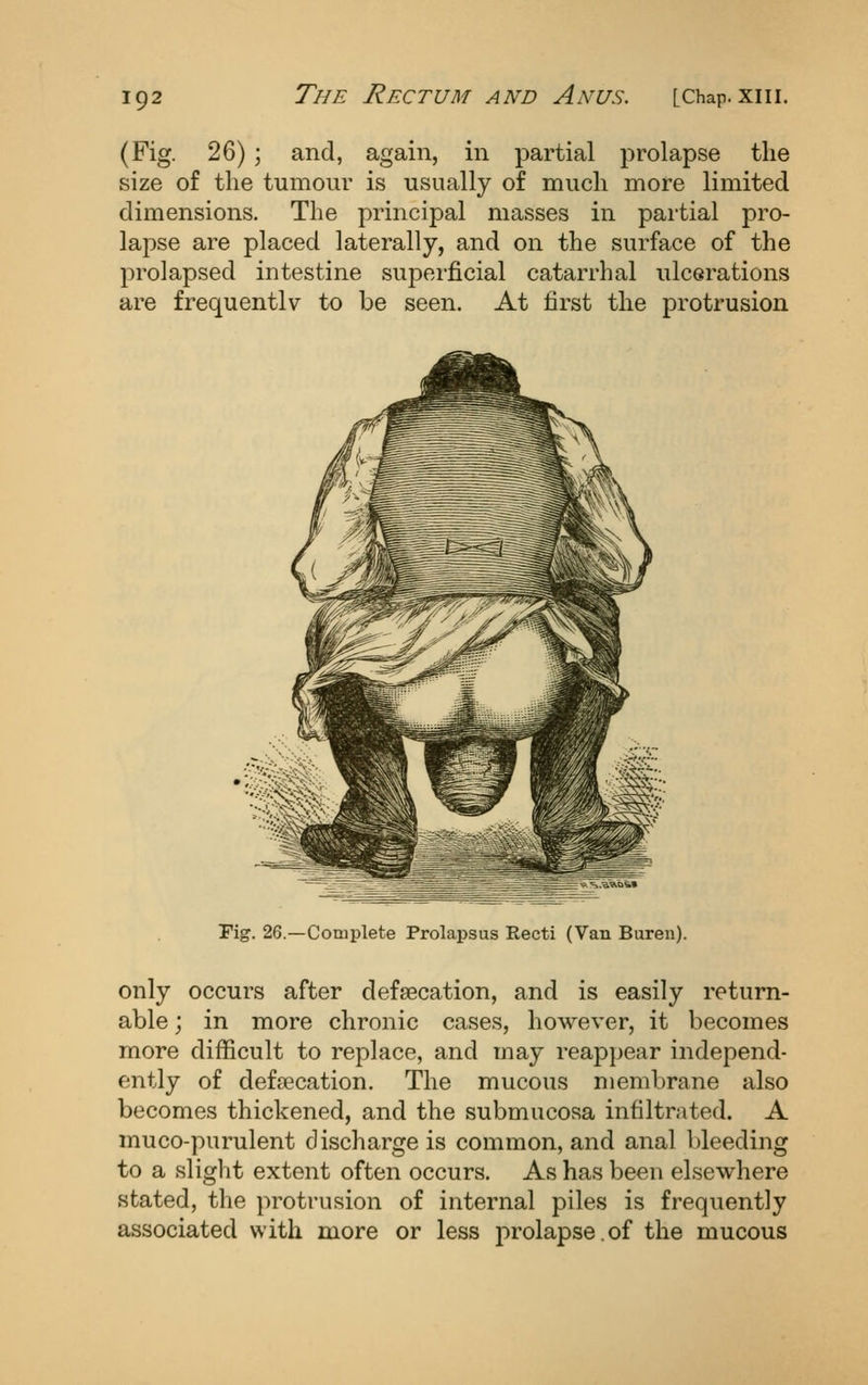 (Fig. 26); and, again, in partial prolapse the size of the tumour is usually of much more limited dimensions. The principal masses in partial pro- lapse are placed laterally, and on the surface of the prolapsed intestine superficial catarrhal ulcerations are frequentlv to be seen. At first the protrusion ^ ^.^ftas» Fig. 26.—Complete Prolapsus Recti (Van Buren). only occurs after defsecation, and is easily return- able ; in more chronic cases, however, it becomes more difficult to replace, and may reappear independ- ently of defaecation. The mucous membrane also becomes thickened, and the submucosa infiltrated. A muco-purulent discharge is common, and anal bleeding to a slight extent often occurs. As has been elsewhere stated, the protrusion of internal piles is frequently associated with more or less prolapse.of the mucous