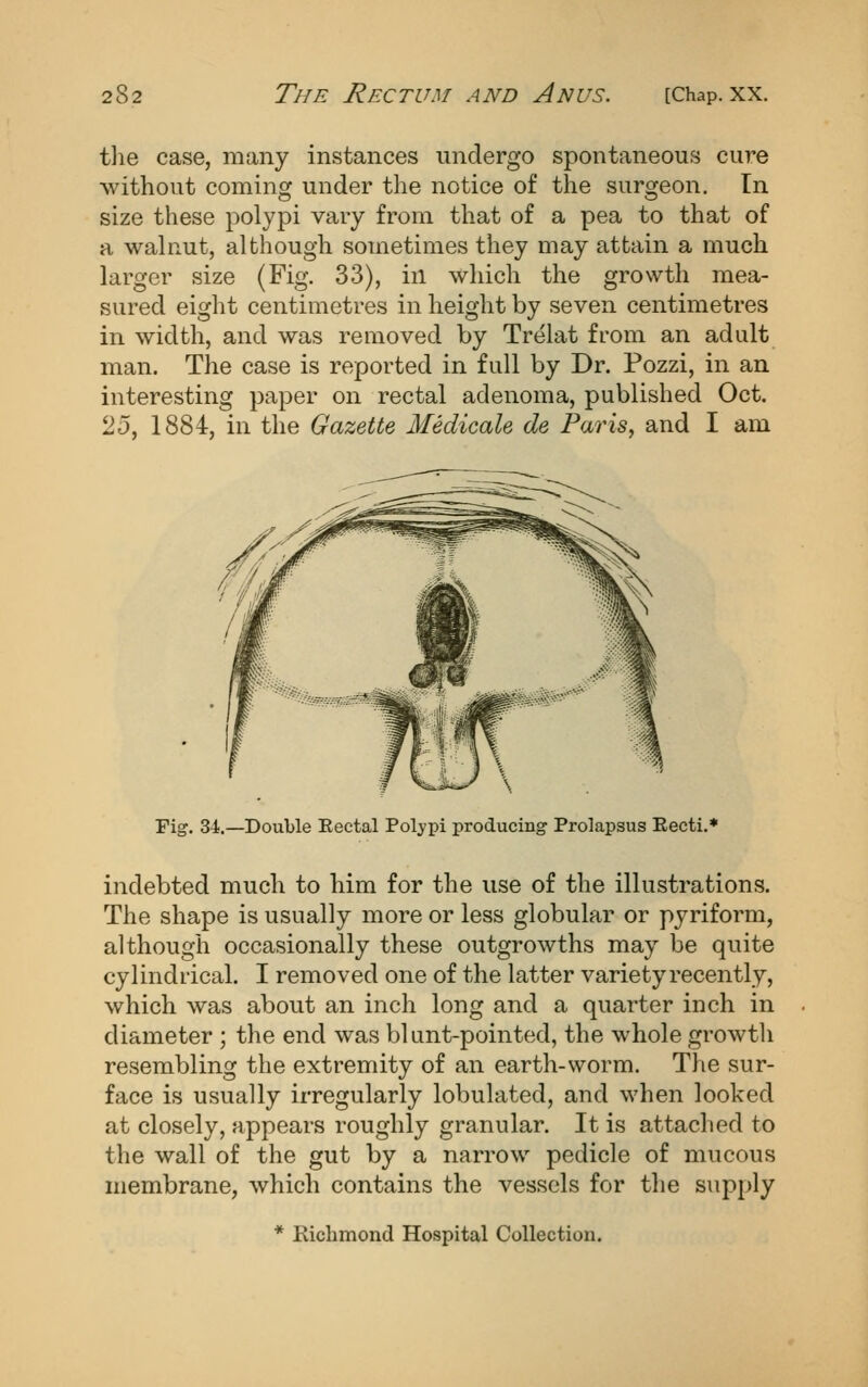 the case, many instances undergo spontaneous cure without coming under the notice of the surgeon. In size these polypi vary from that of a pea to that of a walnut, although sometimes they may attain a much larger size (Fig. 33), in which the growth mea- sured eight centimetres in height by seven centimetres in width, and was removed by Trelat from an adult man. The case is reported in full by Dr. Pozzi, in an interesting paper on rectal adenoma, published Oct. 25, 1884, in the Gazette Medicale de Paris, and I am Fig. 34.—Double Eectal Polypi producing Prolapsus Eecti.* indebted much to him for the use of the illustrations. The shape is usually more or less globular or pyriform, although occasionally these outgrowths may be quite cylindrical. I removed one of the latter variety recently, which was about an inch long and a quarter inch in diameter ; the end was blunt-pointed, the whole growth resembling the extremity of an earth-worm. The sur- face is usually irregularly lobulated, and when looked at closely, appears roughly granular. It is attached to the wall of the gut by a narrow pedicle of mucous membrane, which contains the vessels for the supply * Richmond Hospital Collection.