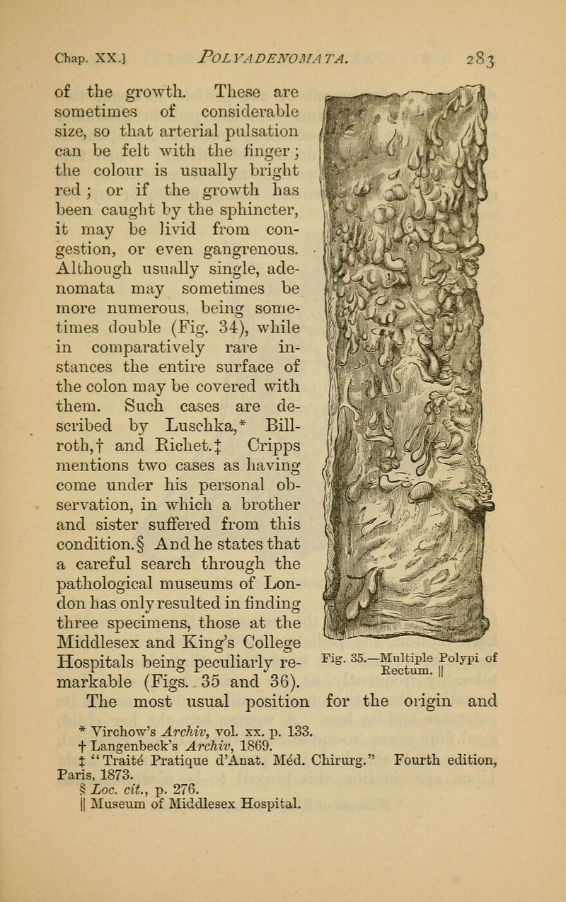 of the growth. These are sometimes of considerable size, so that arterial pulsation can be felt with the finger; the colour is usually bright red; or if the growth has been caught by the sphincter, it may be livid from con- gestion, or even gangrenous. Although usually single, ade- nomata may sometimes be more numerous, being some- times double (Fig. 34), while in comparatively rare in- stances the entire surface of the colon may be covered with them. Such cases are de- scribed by Luschka,* Bill- roth,! and E-ichet.:}: Cripps mentions two cases as having come under his personal ob- servation, in which a brother and sister suffered from this condition.§ And he states that a careful search through the pathological museums of Lon- don has only resulted in finding three specimens, those at the Middlesex and Kind's Colleore Hospitals being peculiarly re- markable (Figs. 35 and 36). The most usual position m ^^ Fig. 35.—Multiple Polypi of Eectum. || for the origin and * Yirchow's ArcMv, vol. xx. p. 133. t Langenbeck's Archiv, 1869. t Traite Pratique d'Anat. Med. Chirurg. Fourth edition, Paris, 1873. § Loc. cit, p. 276. II Museum of Middlesex Hospital.