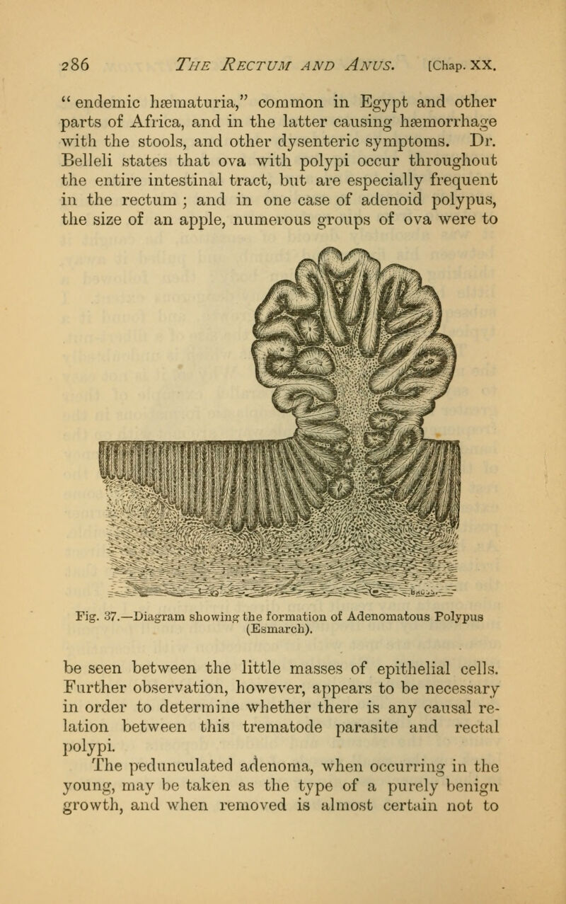 endemic hseraaturia, common in Egypt and other parts of Africa, and in the latter causing haemorrhage with the stools, and other dysenteric symptoms. Dr. Belleli states that ova with polypi occur throughout the entire intestinal tract, but are especially frequent in the rectum ; and in one case of adenoid polypus, the size of an apple, numerous groups of ova were to Fig. 37.—Diagram showing the formation of Adenomatous Polypus (Esmarch). be seen between the little masses of epithelial cells. Further observation, however, appears to be necessary in order to determine whether there is any causal re- lation between this trematode parasite and rectal polypi. The pedunculated adenoma, when occurring in the young, may be taken as the type of a purely benign growth, and when removed is almost certain not to