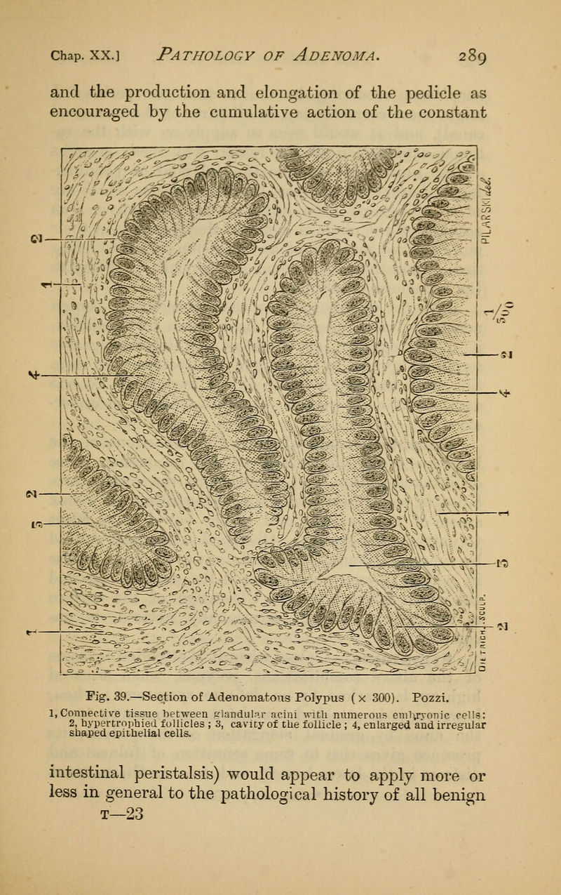 and the production and elongation of the pedicle as encouraged by the cumulative action of the constant f Fig. 39.—Section of Adenomatons Polypus ( x 300). Pozzi. 1,Connective tissue between c'landular acini with numerous enil\rvonic cells; 2, hypertropbied follicles ; 3, cavity of tlie follicle ; 4, enlarged and irregular shaped epithelial cells. t^ intestinal peristalsis) would appear to apply more or less in general to the pathological history of all benign T—23