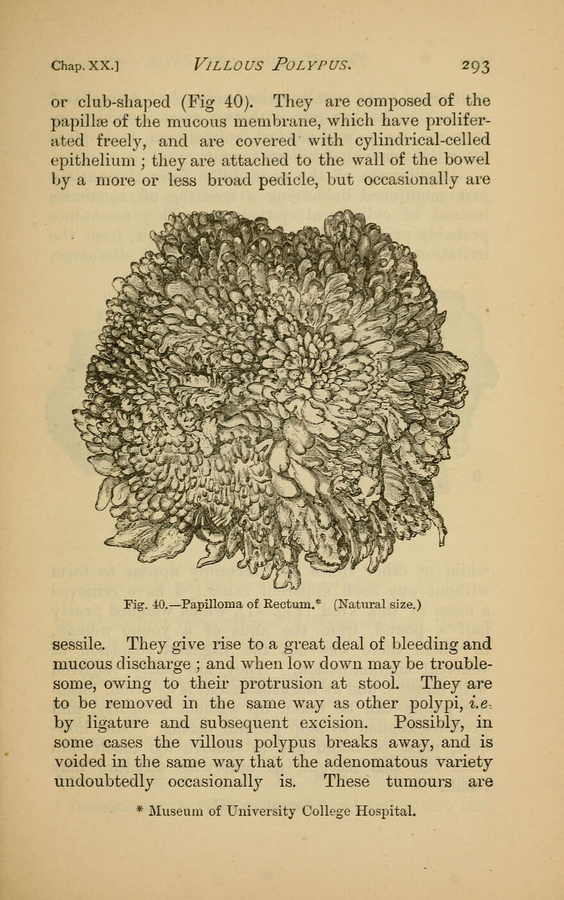 or club-shaped (Fig 40). They are composed of the papillae of the mucous membrane, which have prolifer- ated freely, and are covered with cylindrical-celled epithelium ; they are attached to the wall of the bowel by a more or less broad pedicle, but occasionally are Fig. 40.—Papilloma of Rectum.* (Natural size.) sessile. They give rise to a great deal of bleeding and mucous discharge ; and when low down may be trouble- some, owing to their protrusion at stool. They are to be removed in the same way as other polypi, i.e-. by ligature and subsequent excision. Possibly, in some cases the villous polypus breaks away, and is voided in the same way that the adenomatous variety undoubtedly occasionally is. These tumours are * Museum of University College Hospital.