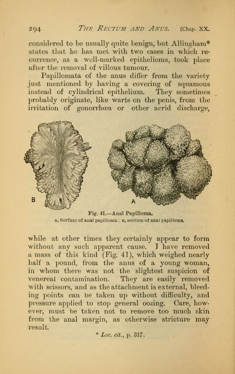 considered to be usually quite benign, but Allinoham* states that he lias met with two cases in which re- currence, as a well-marked epithelioma, took 2)lace after the removal of villous tumour. Papillomata of the anus differ from the variety just mentioned by having a covering of squamous instead of cylindrical epithelium. They sometimes j>robably originate, like warts on the penis, from the irritation of gonorrhoea or other acrid discharge, Fig. 41.—Anal Papilloma. A, Surface of aual papilluma. b, section of anal rapi'loma, while at other times they certainly appear to form without any such apparent cause. T have removed a mass of this kind (Fig. 41), which weighed nearly lialf a ])Ound, from the anus of a young woman, in whom there was not the slightest suspicion of venereal contamination. They are easily removed with scissors, and as the attachment is external, bleed- ing points can be taken up without difficulty, and pressure applied to stop general oozing. Care, how- ever, must be taken not to remove too much skin from the anal margin, as otherwise stricture may result.