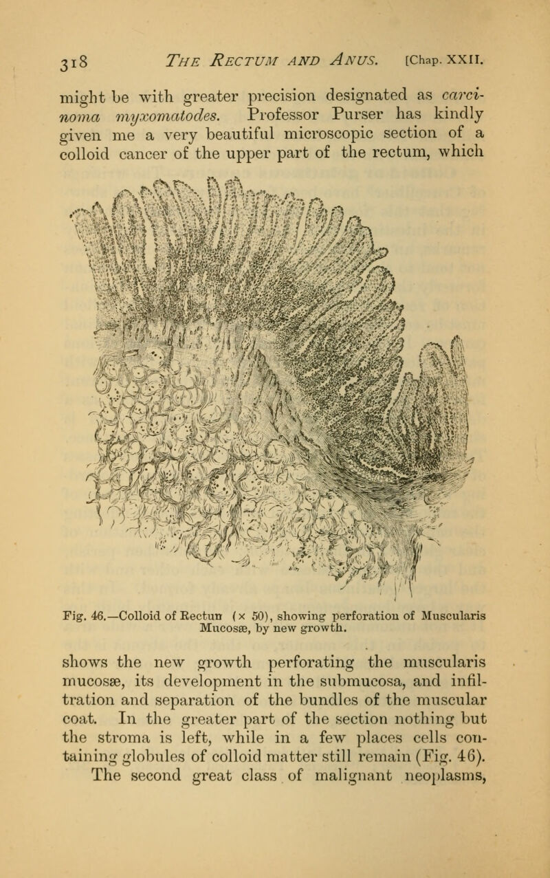 might be with greater precision designated as carci- noma myxomatodes. Professor Purser has kindly given me a very beautiful microscopic section of a colloid cancer of the upper part of the rectum, which Fig. 46.—Colloid of Rectun (x 50), showing perforation of Muscularis Mucosae, by new growth. shows the new growth perforating the muscularis mucosae, its development in the submucosa, and infil- tration and separation of the bundles of the muscular coat. In the greater part of the section nothing but the stroma is left, while in a few places cells con- taining globules of colloid matter still remain (Fig. 46). The second great class of malignant neoplasms,
