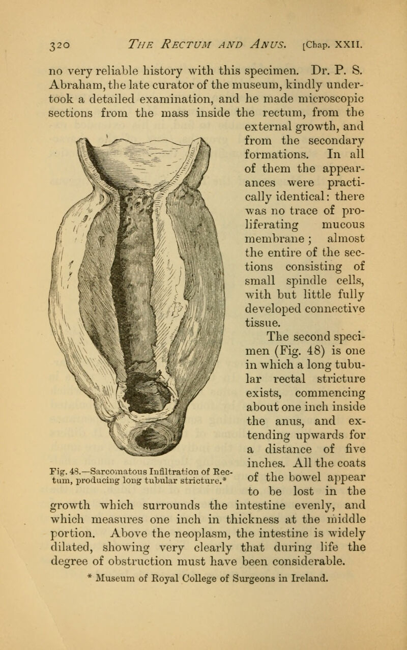 no very reliable history with this specimen. Dr. P. S. Abraham, the late curator of the museum, kindly under- took a detailed examination, and he made microscopic sections from the mass inside the rectum, from the external growth, and from the secondary formations. In all of them the appear- ances were practi- cally identical: there was no trace of pro- liferating mucous membrane; almost the entire of the sec- tions consisting of small spindle cells, with but little fully developed connective tissue. The second speci- men (Fig. 48) is one in which a long tubu- lar rectal stricture exists, commencing about one inch inside the anus, and ex- tending upwards for a distance of five inches. All the coats of the bowel ajipear to be lost in the growth which surrounds the intestine evenly, and which measures one inch in thickness at the middle portion. Above the neoplasm, the intestine is widely dilated, showing very clearly that during life the degree of obstruction must have been considerable. * Museum of Royal College of Surgeons in Ireland. Fig. 4>?.—Sarcomatous lufiltrafion of Rec turn, producing loug tubular stricture.*