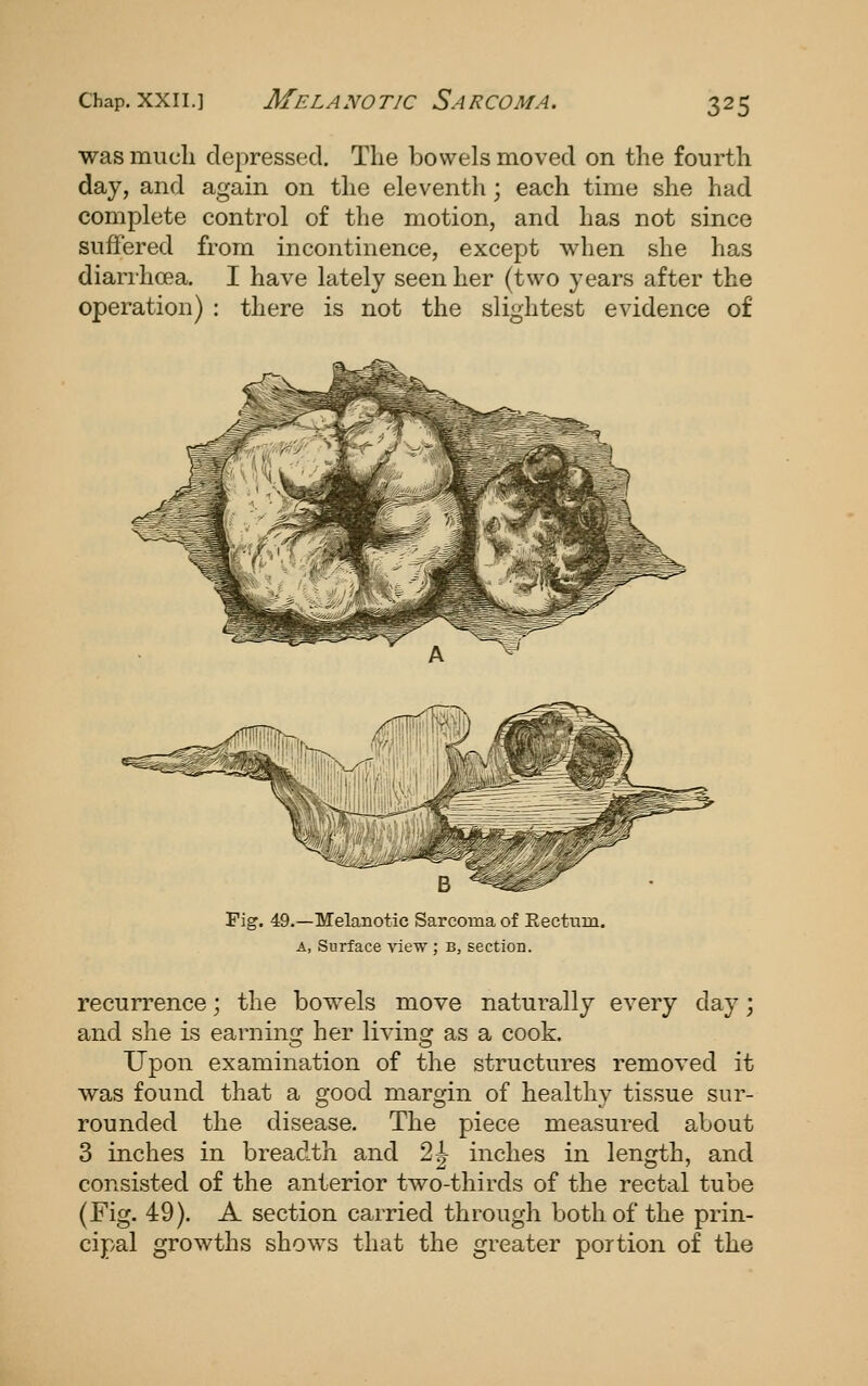 was mucli depressed. The bowels moved on the fourth day, and again on the eleventh; each time she had complete control of the motion, and has not since suffered from incontinence, except when she has diarrhoea. I have lately seen her (two years after the operation) : there is not the slightest evidence of Pig. 49.—Melanotic Sarcoma of Eectum. A, Surface view ; b, section. recurrence; the bowels move naturally every day; and she is earning her living as a cook. Upon examination of the structures removed it was found that a good margin of healthy tissue sur- rounded the disease. The piece measured about 3 inches in breadth and 2^ inches in length, and consisted of the anterior two-thirds of the rectal tube (Fig. 49). A section carried through both of the prin- cipal growths shows that the greater portion of the