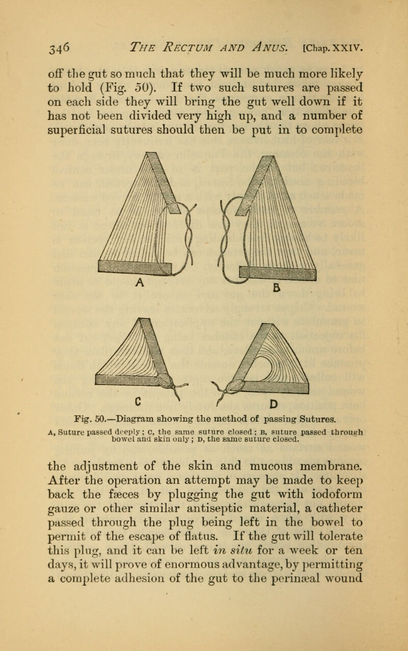 off tlie gut so irmcli that they will be much more likely to hold (Fig. 50). If two such sutures are passed on each side they will bring the gut well down if it has not been divided very high up, and a number of superficial sutures should then be put in to complete c ' r D Fig. 50.—Diagram showing the method of passing Sutures. A, Suture passed (li'eply; c, the sarae suture closed; b, suture passed throut-'h bowel and skin only; D, the same suture closed. the adjustment of the skin and mucous membrane. After the operation an attempt may be made to keep back the faeces by plugging the gut with iodoform gauze or other similar antiseptic material, a catheter passed through the plug being left in the bowel to permit of the escai)e of flatus. If the gut will tolerate this plug, and it can be left in situ for a week or ten days, it will prove of enormous advantage, by permitting a complete adhesion of the gut to the perinaeal wound