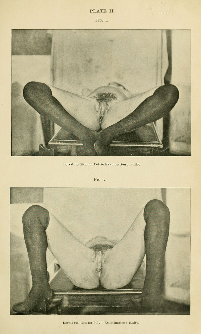 PLATE II. Fig. 1. Dorsal Position for Pelvic Examination : faulty. Fig. 2. Dorsal Position for Pelvic Examination : faulty.