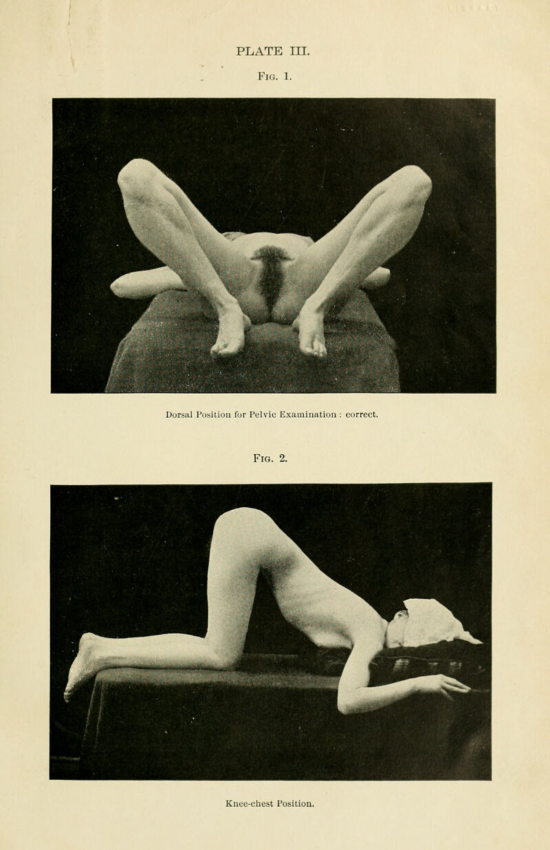 PLATE III. Fig. 1. Dorsal Position for Pelvic Examination : correct. Fig. 2. Knee-chest Position.