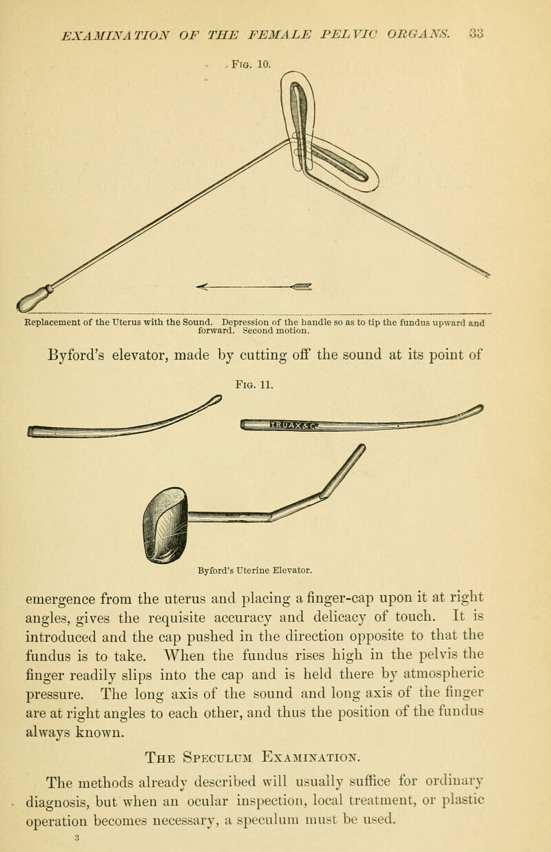 . Fig. 10. Replacement of the Uterus with the Sound. Depression of the handle so as to tip the fundus upward and forward. Second motion. Byford's elevator, made by cutting off the sound at its point of Fig. 11. Byford's Uterine Elevator. emergence from the uterus and placing a finger-cap upon it at right angles, gives the requisite accuracy and delicacy of touch. It is introduced and the cap pushed in the direction opposite to that the fundus is to take. When the fundus rises high in the pelvis the finger readily slips into the cap and is held there by atmospheric pressure. The long axis of the sound and long axis of the finger are at right angles to each other, and thus the position of the fundus always known. The Speculum Examination. The methods already described will usually suffice for ordinary diagnosis, but when an ocular inspection, local treatment, or plastic operation becomes necessary, a speculum must be used.