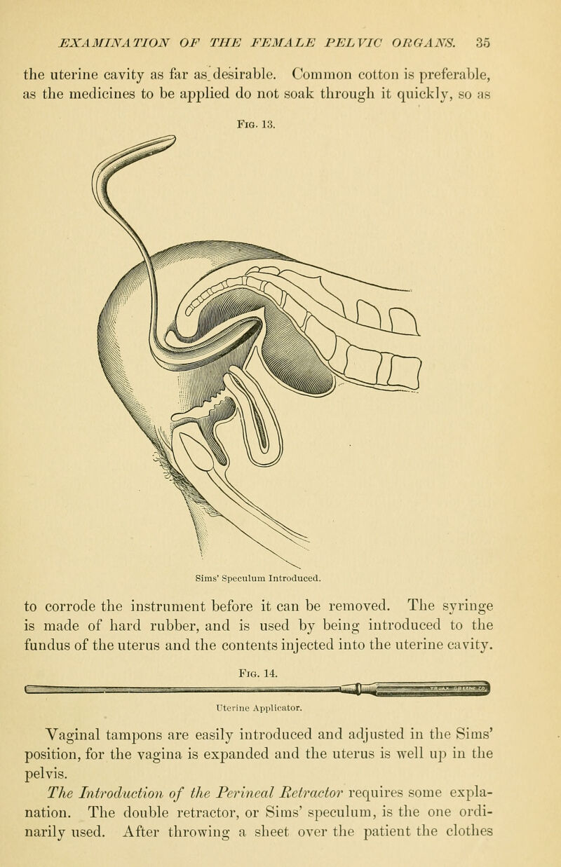 the uterine cavity as far as.desirable. Common cotton is preferable, as the medicines to be applied do not soak through it quickly, so as Fig. 13. Sims' Speculum Introduced. to corrode the instrument before it can be removed. The syringe is made of hard rubber, and is used by being introduced to the fundus of the uterus and the contents injected into the uterine cavity. Fig. 14. Uterine Applicator. Vaginal tampons are easily introduced and adjusted in the Sims' position, for the vagina is expanded and the uterus is well up in the pelvis. The Introduction of the Perineal Retractor requires some expla- nation. The double retractor, or Sims' speculum, is the one ordi- narily used. After throwing a sheet over the patient the clothes