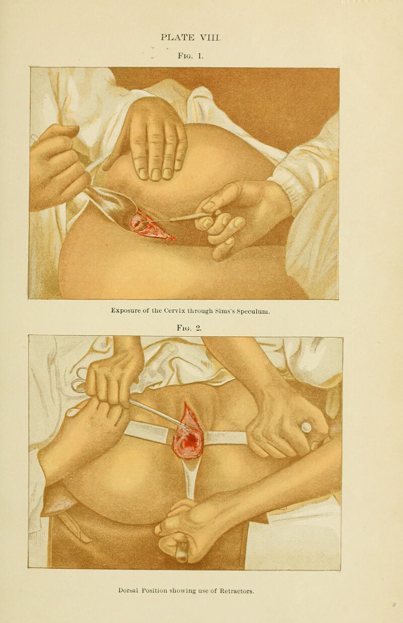 PLATE VTTT. Fig. 1. Exposure of the Cervix through Sims's Speculum. Fiu. 2. Dorsal Position showing use of Retractors.