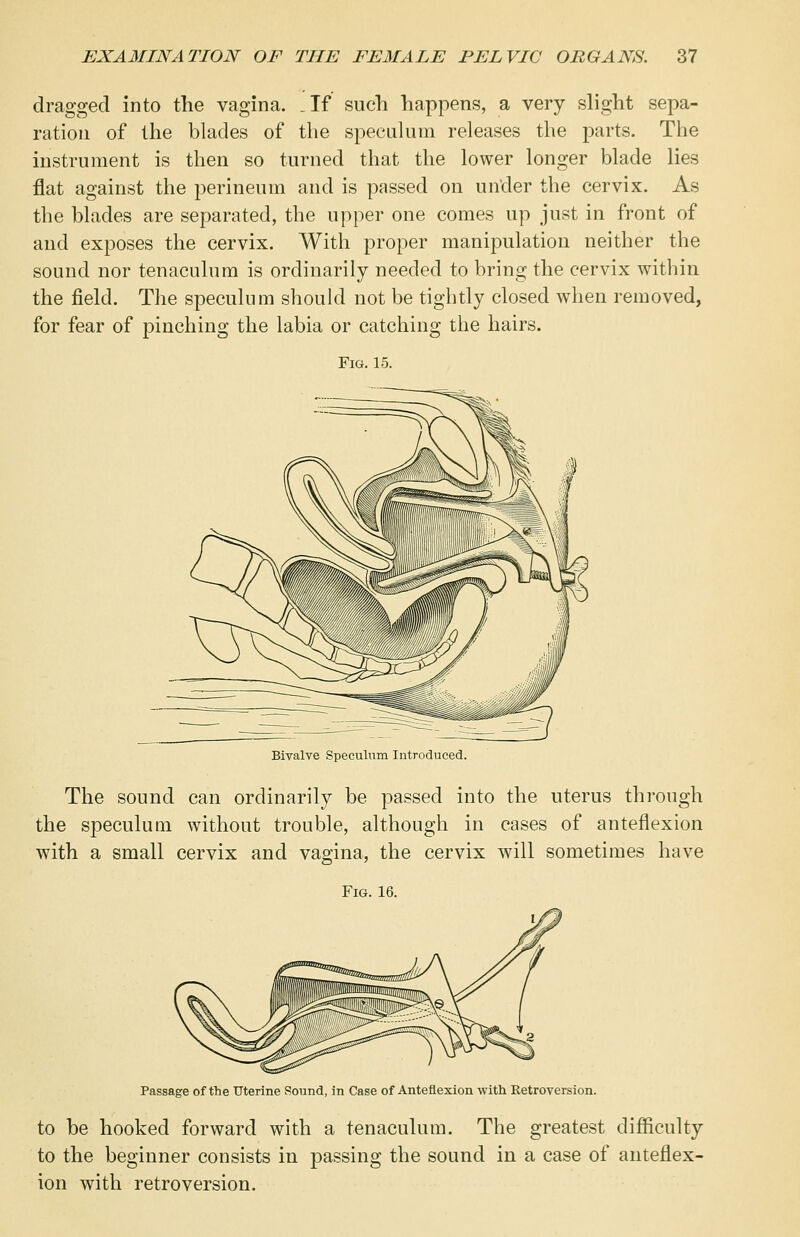 dragged into the vagina. _If such happens, a very slight sepa- ration of the blades of the speculum releases the parts. The instrument is then so turned that the lower longer blade lies flat against the perineum and is passed on under the cervix. As the blades are separated, the upper one comes up just in front of and exposes the cervix. With proper manipulation neither the sound nor tenaculum is ordinarily needed to bring the cervix within the field. The speculum should not be tightly closed when removed, for fear of pinching the labia or catching the hairs. Fig. 15. Bivalve Speculum Introduced. The sound can ordinarily be passed into the uterus through the speculum without trouble, although in cases of anteflexion with a small cervix and vagina, the cervix will sometimes have Fig. 16. Passage of the Uterine Sound, in Case of Anteflexion with Retroversion. to be hooked forward with a tenaculum. The greatest difficulty to the beginner consists in passing the sound in a case of anteflex- ion with retroversion.