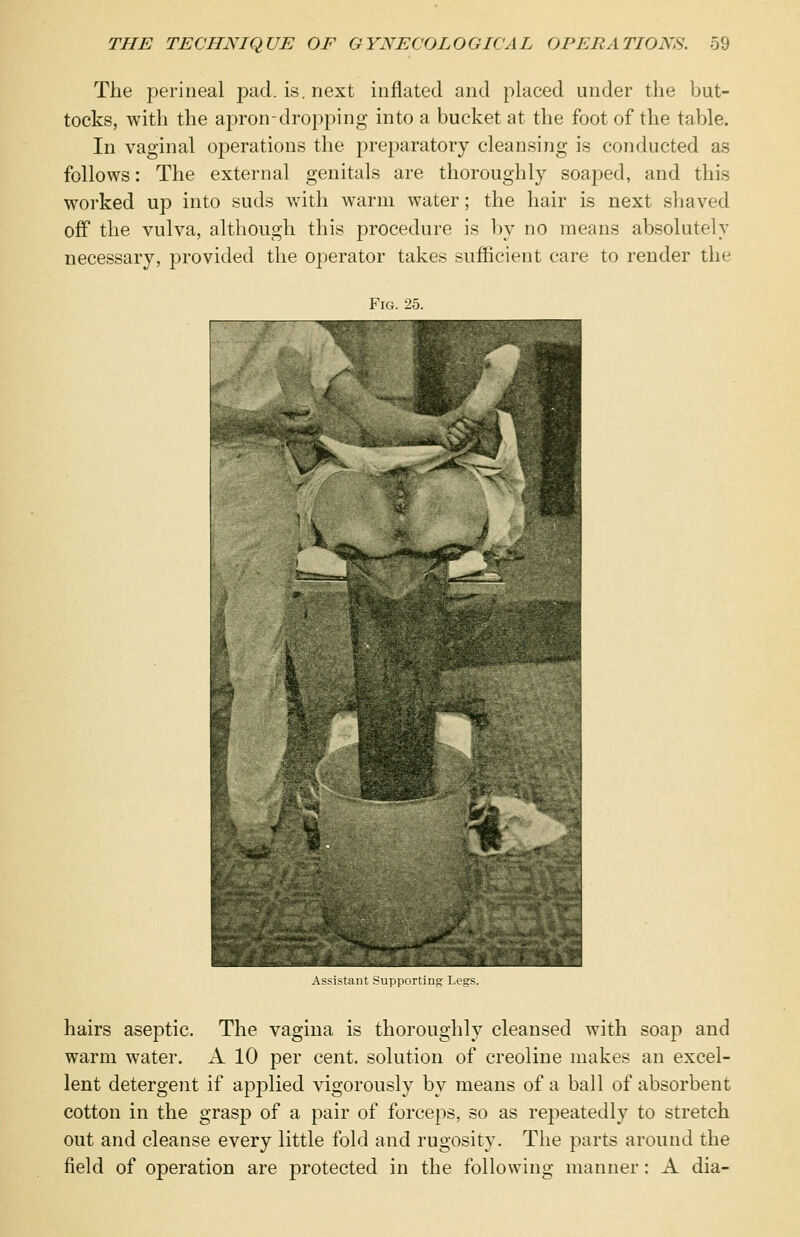 The perineal pad. is. next inflated and placed under the but- tocks, with the apron-dropping into a bucket at the foot of the table. In vaginal operations the preparatory cleansing is conducted as follows: The external genitals are thoroughly soaped, and this worked up into suds with warm water; the hair is next shaved off the vulva, although this procedure is by no means absolutely necessary, provided the operator takes sufficient care to render the Fig. 25. Assistant Supporting Legs. hairs aseptic. The vagina is thoroughly cleansed with soap and warm water. A 10 per cent, solution of creoline makes an excel- lent detergent if applied vigorously by means of a ball of absorbent cotton in the grasp of a pair of forceps, so as repeatedly to stretch out and cleanse every little fold and rugosity. The parts around the field of operation are protected in the following manner: A dia-