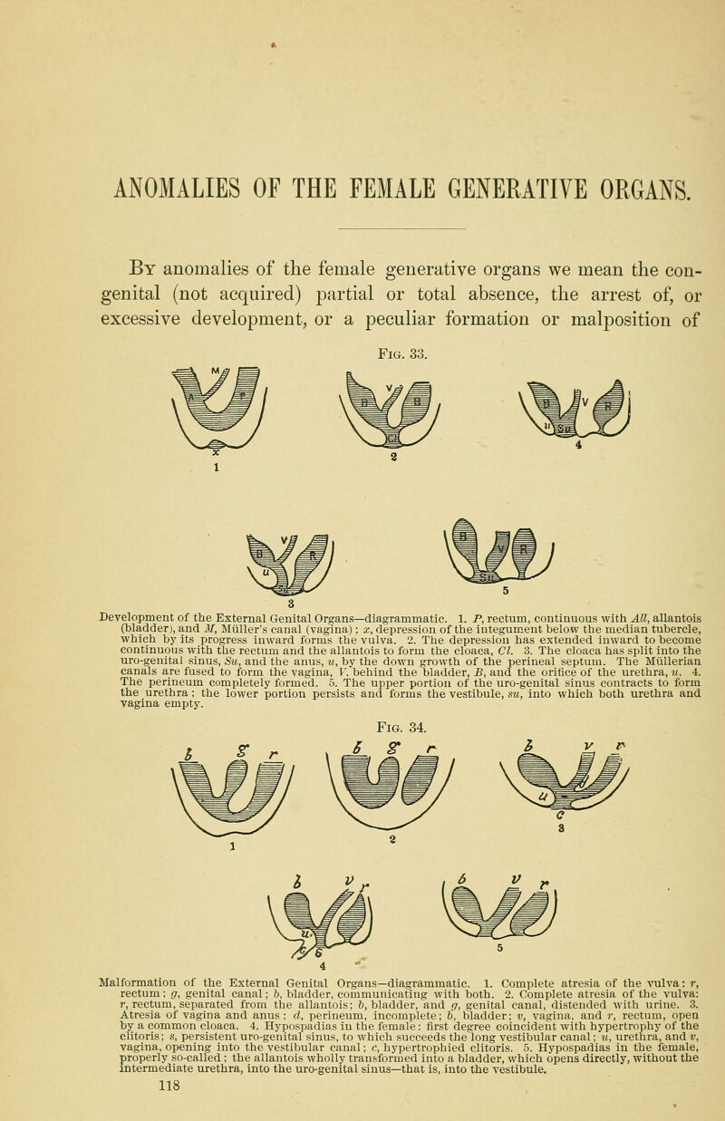 ANOMALIES OF THE FEMALE GENERATIVE ORGANS. By anomalies of the female generative organs we mean the con- genital (not acquired) partial or total absence, the arrest of, or excessive development, or a peculiar formation or malposition of Fig. 33. Development of the External Genital Organs—diagrammatic. 1. P, rectum, continuous with All, allantois (bladder), and 31, Midler's canal (vagina); x, depression of the integument below the median tubercle, which by its progress inward forms the vulva. 2. The depression has extended inward to become continuous with the rectum and the allantois to form the cloaca, CI. 3. The cloaca has split into the uro-genital sinus, Su, and the anus, u, by the down growth of the perineal septum. The Miillerian canals are fused to form the vagina, V, behind the bladder, B, and the orifice of the urethra, u. 4. The perineum completely formed. 5. The upper portion of the uro-genital sinus contracts to form the urethra; the lower portion persists and forms the vestibule, su, into which both urethra and vagina empty. Malformation of the External Genital Organs—diagrammatic. 1. Complete atresia of the vulva: r, rectum; g, genital canal; b, bladder, communicating with both. 2. Complete atresia of the vulva: r, rectum, separated from the allantois; 6, bladder, and g, genital canal, distended with urine. 3. Atresia of vagina and anus: d, perineum, incomplete; b, bladder; v, vagina, and r, rectum, open by a common cloaca. 4. Hypospadias in the female: first degree coincident with hypertrophy of the clitoris; s, persistent uro-genital sinus, to which succeeds thelong vestibular canal; u, urethra, and v, vagina, opening into the vestibular canal; c, hypertrophied clitoris. 5. Hypospadias in the female, properly so-called ; the allantois wholly transformed into a bladder, which opens directly, without the intermediate urethra, into the uro-genital sinus—that is, into the vestibule.