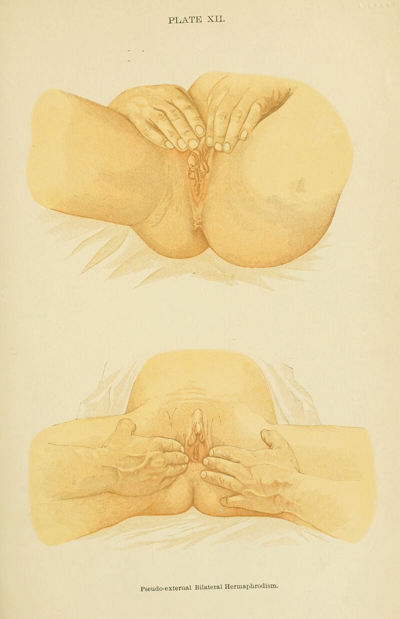 PLATE XII. m Pseudo-external Bilateral Hermaphrodism.