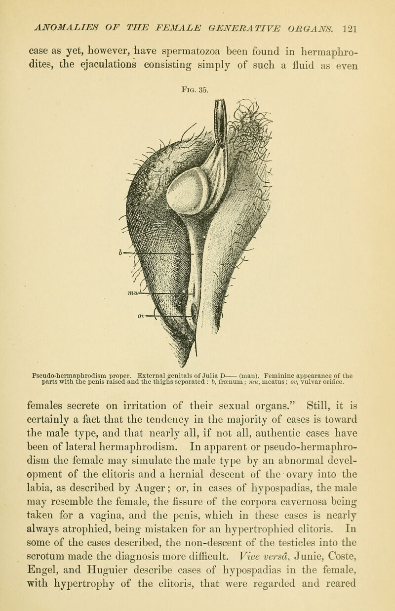 case as yet, however, have spermatozoa been found in hermaphro- dites, the ejaculations consisting simply of such a fluid as even Fig. 35. Pseudo-hermaphrodism proper. External genitals of Julia D (man). Feminine appearance of the parts with the penis raised and the thighs separated : b, frsenum; tow, meatus; ov, vulvar orifice. females secrete on irritation of their sexual organs. Still, it is certainly a fact that the tendency in the majority of cases is toward the male type, and that nearly all, if not all, authentic cases have been of lateral hermaphroclism. In apparent or pseudo-hermaphro- dism the female may simulate the male type by an abnormal devel- opment of the clitoris and a hernial descent of the ovary into the labia, as described by Auger; or, in cases of hypospadias, the male may resemble the female, the fissure of the corpora cavernosa being taken for a vagina, and the penis, which in these cases is nearly always atrophied, being mistaken for an hypertrophied clitoris. In some of the cases described, the non-descent of the testicles into the scrotum made the diagnosis more difficult. Vice versa, Junie, Coste, Engel, and Huguier describe cases of hypospadias in the female, with hypertrophy of the clitoris, that were regarded and reared