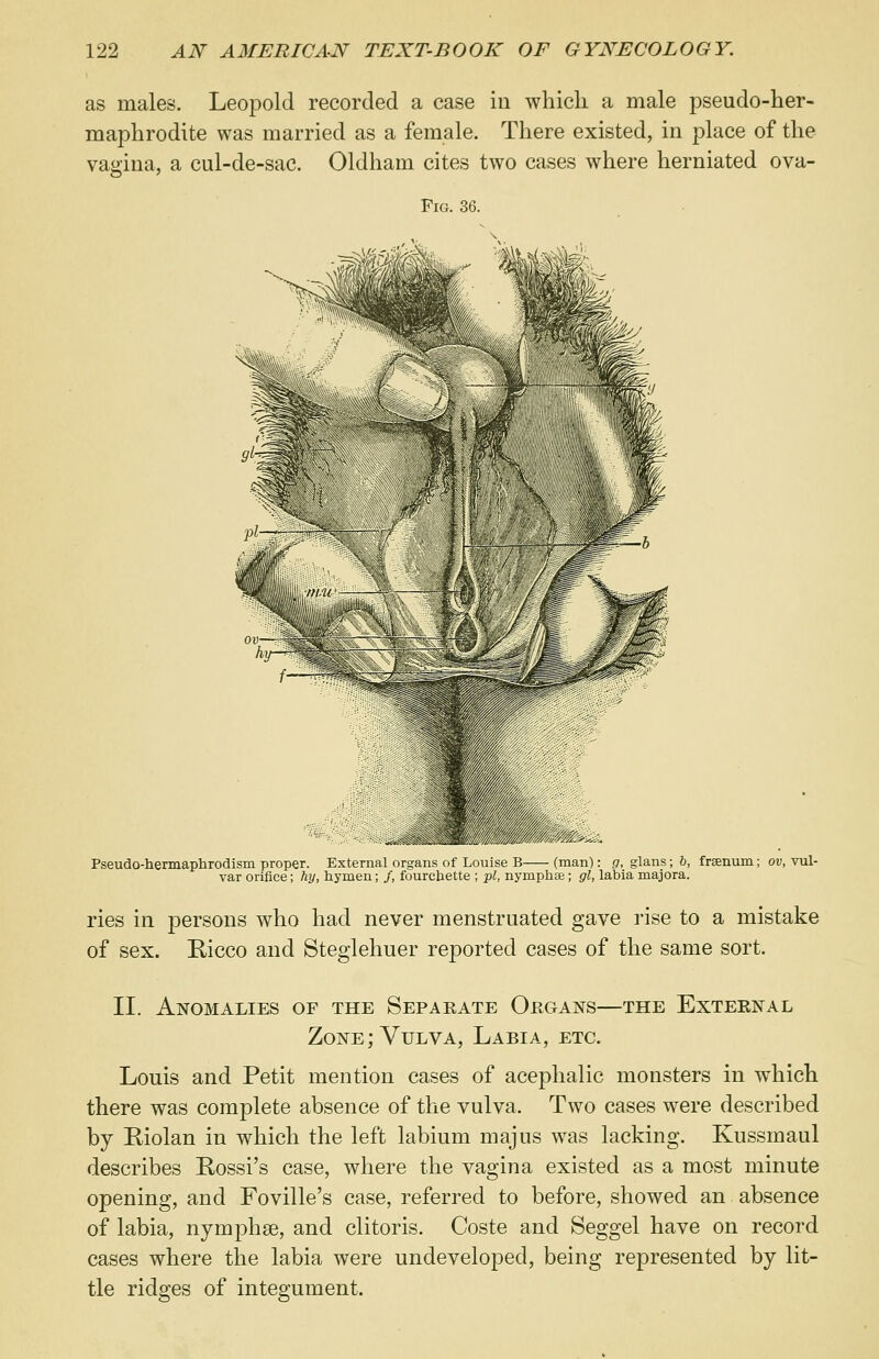 as males. Leopold recorded a case in which a male pseudo-her- maphrodite was married as a female. There existed, in place of the vagina, a cul-de-sac. Oldham cites two cases where herniated ova- Fig. 36. Pseudo-hermaphrodism proper. External organs of Louise B (man): g, glans; b, frsenum; ov, vul- var orifice; hy, hymen; /, fourcbette ; pi, nymphse; gl, labia majora. ries in persons who had never menstruated gave rise to a mistake of sex. Rieco and Steglehuer reported cases of the same sort. II. Anomalies of the Separate Organs—the External Zone; Vulva, Labia, etc. Louis and Petit mention cases of acephalic monsters in which there was complete absence of the vulva. Two cases were described by Riolan in which the left labium majus was lacking. Kussmaul describes Rossi's case, where the vagina existed as a most minute opening, and Foville's case, referred to before, showed an absence of labia, nymphse, and clitoris. Coste and Seggel have on record cases where the labia were undeveloped, being represented by lit- tle ridges of integument.